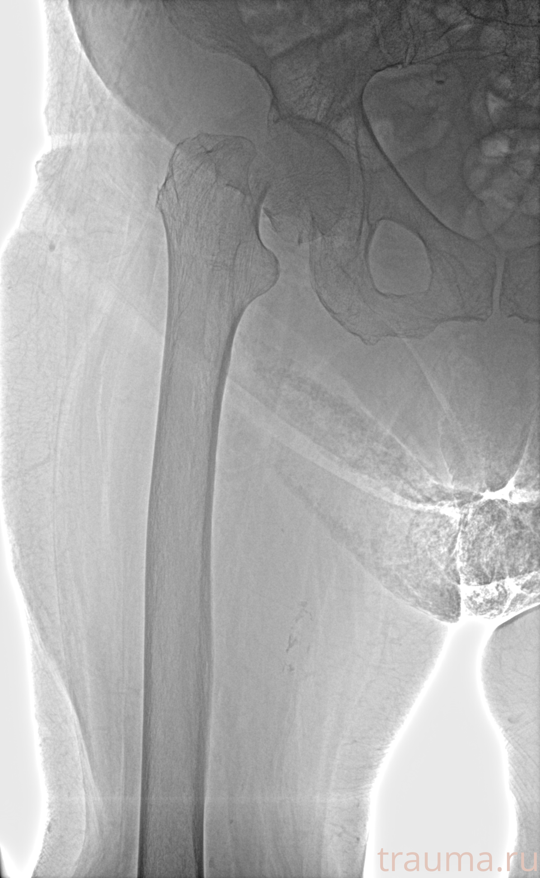 Рентген на дому: по вашему адресу приезжает врач-рентгенолог, травматолог-ортопед с мобильным рентгеновским аппаратом, проводит диагностику травмы или заболевания, делает необходимые рентгенограммы, дает рекомендации по дальнейшему лечению. Получить качественные снимки в домашних условиях возможно благодаря уникальной методике, разработанной МосРентген Центром для института  Склифосовского