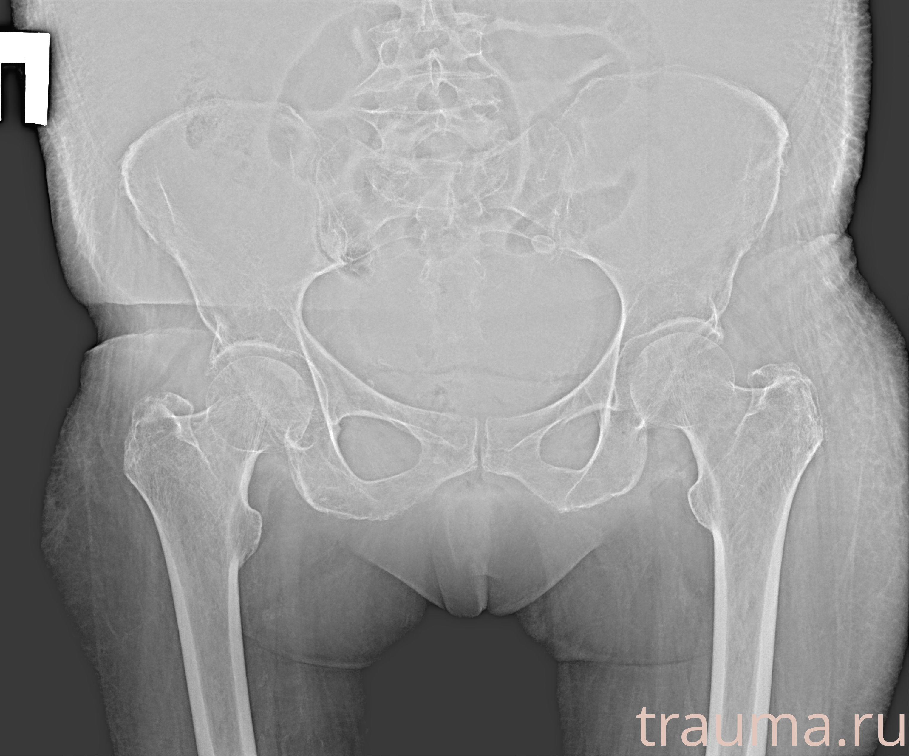 Рентген на дому: по вашему адресу приезжает врач-рентгенолог, травматолог-ортопед с мобильным рентгеновским аппаратом, проводит диагностику травмы или заболевания, делает необходимые рентгенограммы, дает рекомендации по дальнейшему лечению. Получить качественные снимки в домашних условиях возможно благодаря уникальной методике, разработанной МосРентген Центром для института  Склифосовского