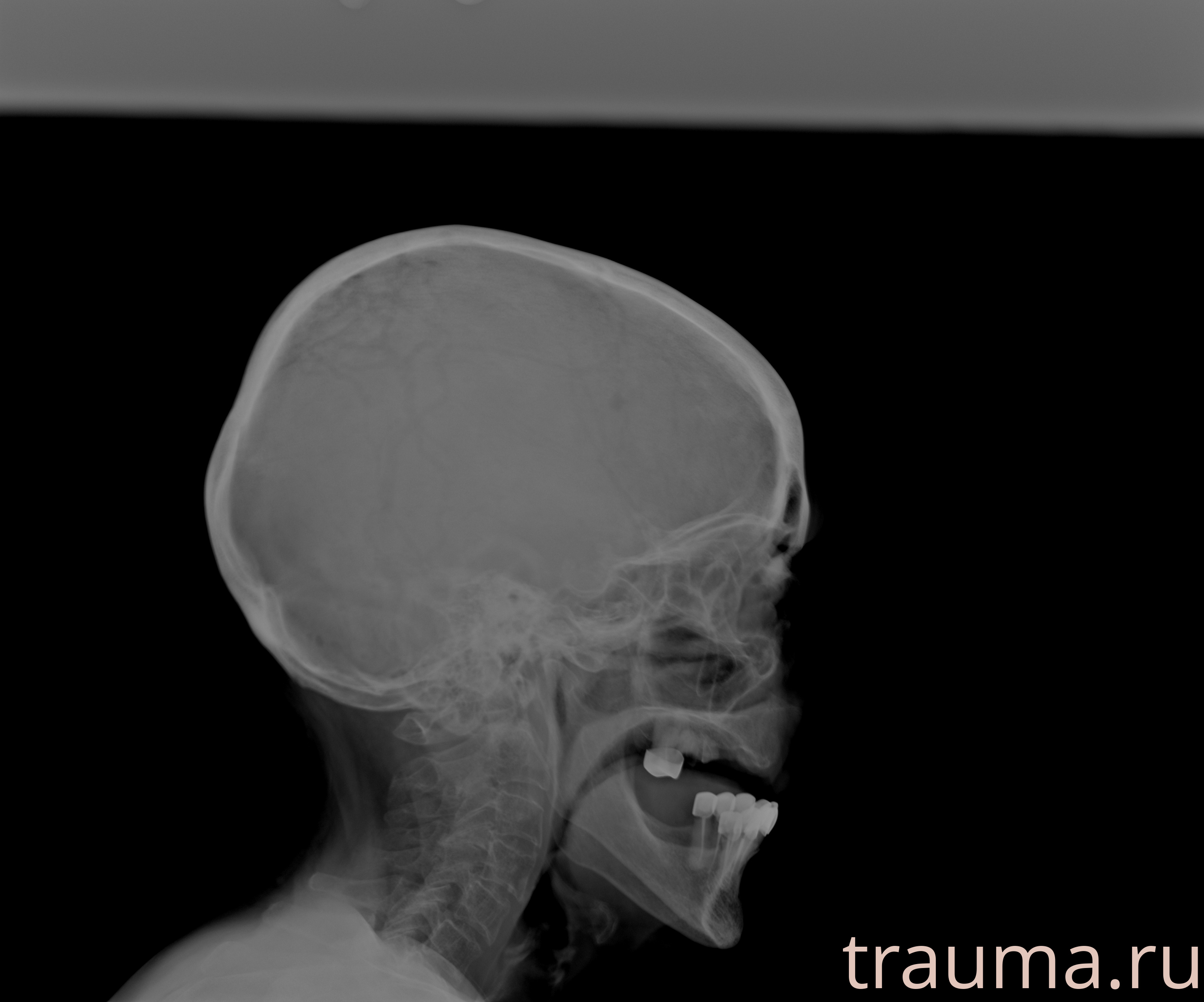 Рентген на дому: по вашему адресу приезжает врач-рентгенолог, травматолог-ортопед с мобильным рентгеновским аппаратом, проводит диагностику травмы или заболевания, делает необходимые рентгенограммы, дает рекомендации по дальнейшему лечению. Получить качественные снимки в домашних условиях возможно благодаря уникальной методике, разработанной МосРентген Центром для института  Склифосовского