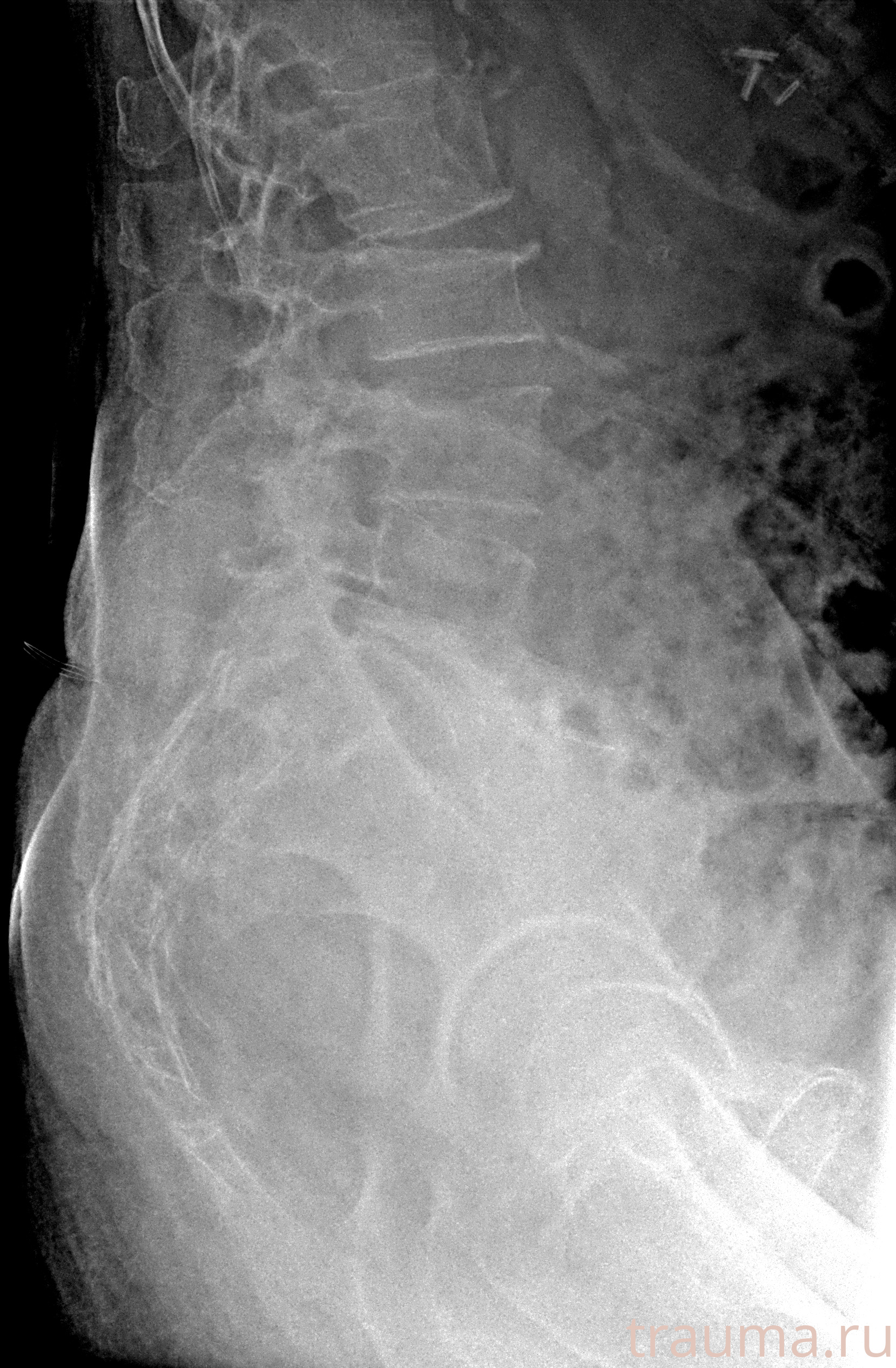 Рентген на дому: по вашему адресу приезжает врач-рентгенолог, травматолог-ортопед с мобильным рентгеновским аппаратом, проводит диагностику травмы или заболевания, делает необходимые рентгенограммы, дает рекомендации по дальнейшему лечению. Получить качественные снимки в домашних условиях возможно благодаря уникальной методике, разработанной МосРентген Центром для института  Склифосовского