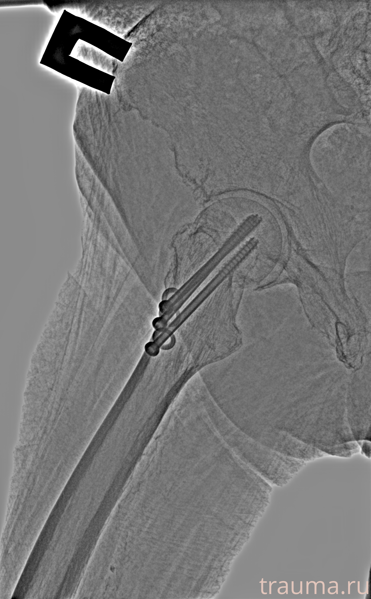 Рентген на дому: по вашему адресу приезжает врач-рентгенолог, травматолог-ортопед с мобильным рентгеновским аппаратом, проводит диагностику травмы или заболевания, делает необходимые рентгенограммы, дает рекомендации по дальнейшему лечению. Получить качественные снимки в домашних условиях возможно благодаря уникальной методике, разработанной МосРентген Центром для института  Склифосовского