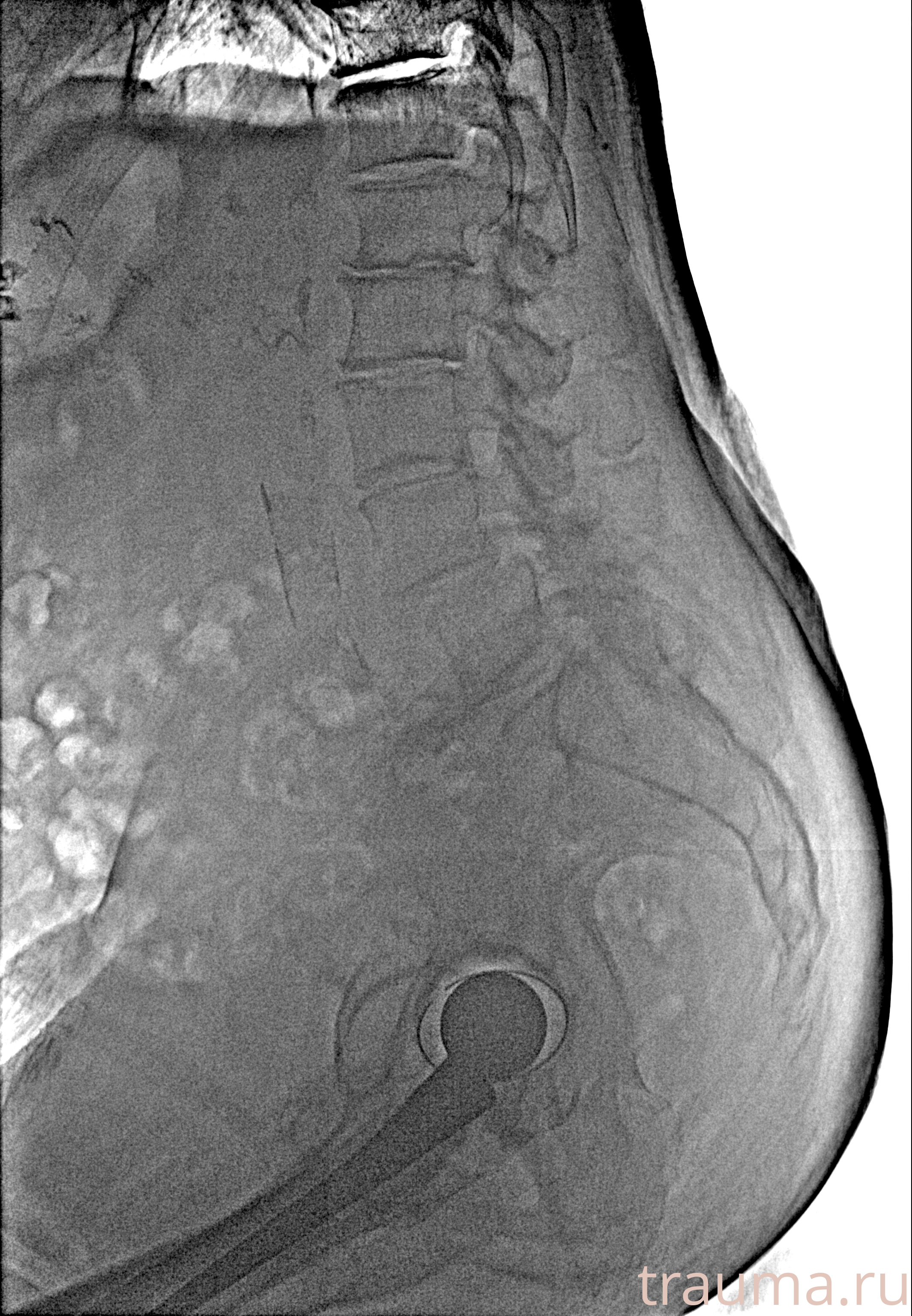 Рентген на дому: по вашему адресу приезжает врач-рентгенолог, травматолог-ортопед с мобильным рентгеновским аппаратом, проводит диагностику травмы или заболевания, делает необходимые рентгенограммы, дает рекомендации по дальнейшему лечению. Получить качественные снимки в домашних условиях возможно благодаря уникальной методике, разработанной МосРентген Центром для института  Склифосовского