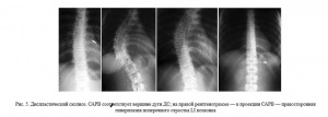 Сравнительный рентгенологический анализ остеорепарации после радикально-восстановительных операций, проведенных с использованием различных пластических материалов у детей с деструктивными поражениями костей Сравнительный рентгенологический анализ остеорепарации после радикально-восстановительных операций, проведенных с использованием различных пластических материалов у детей с деструктивными поражениями костей