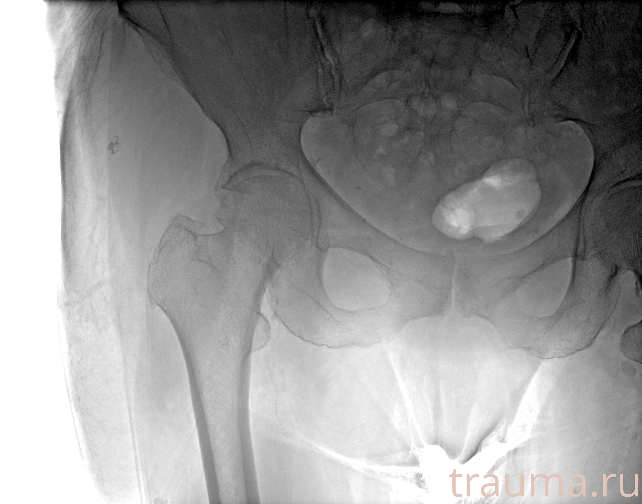 Рентген на дому: по вашему адресу приезжает врач-рентгенолог, травматолог-ортопед с мобильным рентгеновским аппаратом, проводит диагностику травмы или заболевания, делает необходимые рентгенограммы, дает рекомендации по дальнейшему лечению. Получить качественные снимки в домашних условиях возможно благодаря уникальной методике, разработанной МосРентген Центром для института  Склифосовского