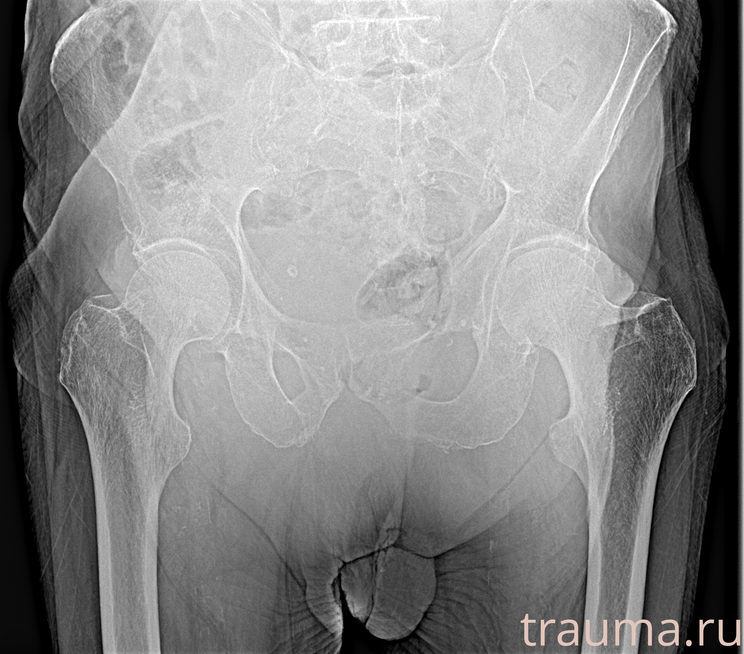 Рентген на дому: по вашему адресу приезжает врач-рентгенолог, травматолог-ортопед с мобильным рентгеновским аппаратом, проводит диагностику травмы или заболевания, делает необходимые рентгенограммы, дает рекомендации по дальнейшему лечению. Получить качественные снимки в домашних условиях возможно благодаря уникальной методике, разработанной МосРентген Центром для института  Склифосовского