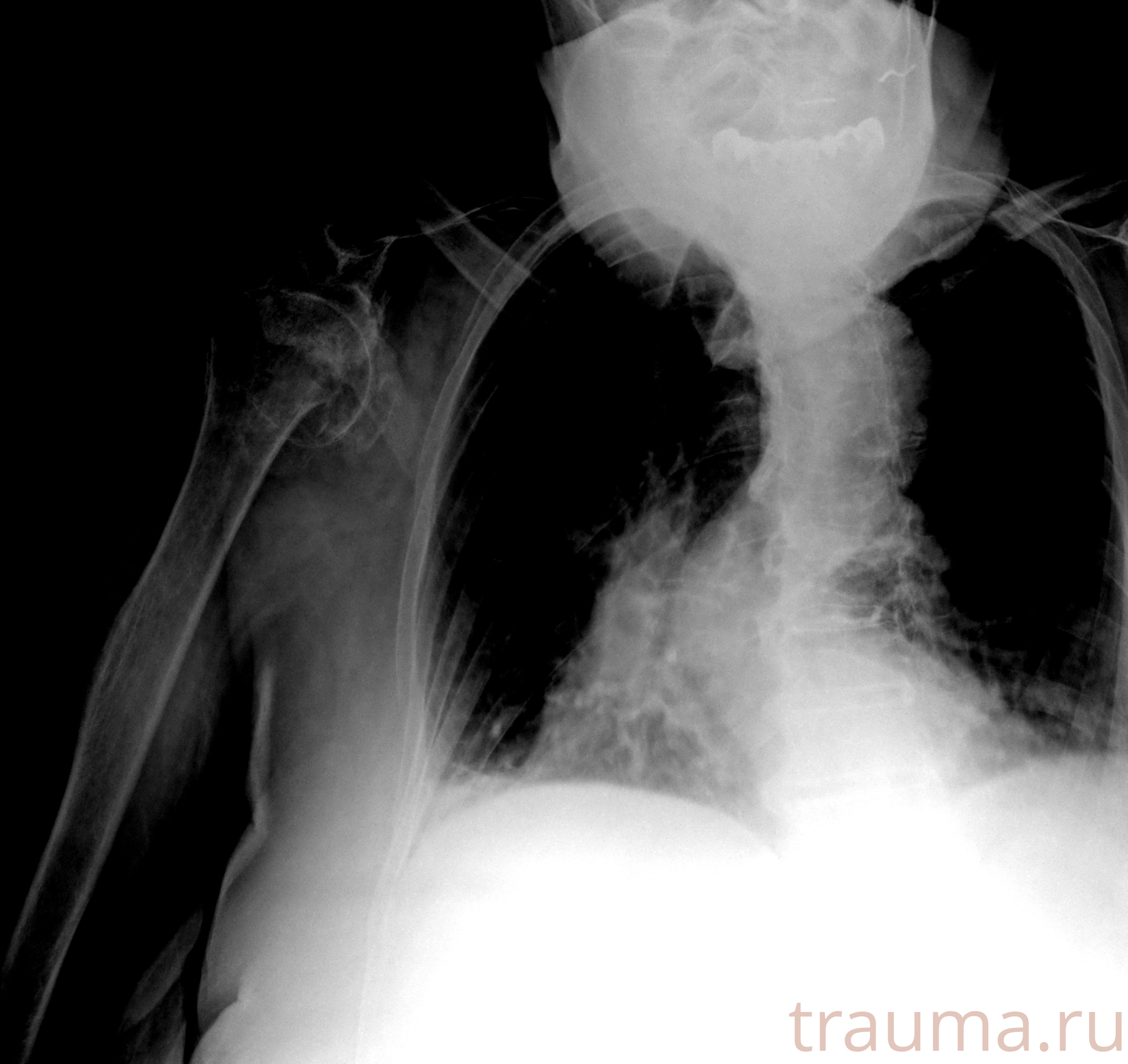 Рентген на дому: по вашему адресу приезжает врач-рентгенолог, травматолог-ортопед с мобильным рентгеновским аппаратом, проводит диагностику травмы или заболевания, делает необходимые рентгенограммы, дает рекомендации по дальнейшему лечению. Получить качественные снимки в домашних условиях возможно благодаря уникальной методике, разработанной МосРентген Центром для института  Склифосовского