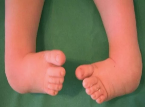 Клинический случай врожденной аномалии костно-суставной системы «тазовый палец», методы диагностики