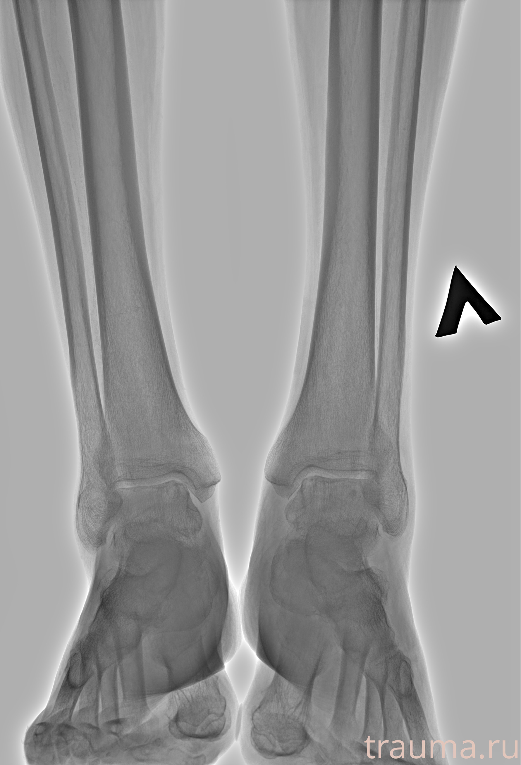 Рентген на дому: по вашему адресу приезжает врач-рентгенолог, травматолог-ортопед с мобильным рентгеновским аппаратом, проводит диагностику травмы или заболевания, делает необходимые рентгенограммы, дает рекомендации по дальнейшему лечению. Получить качественные снимки в домашних условиях возможно благодаря уникальной методике, разработанной МосРентген Центром для института  Склифосовского
