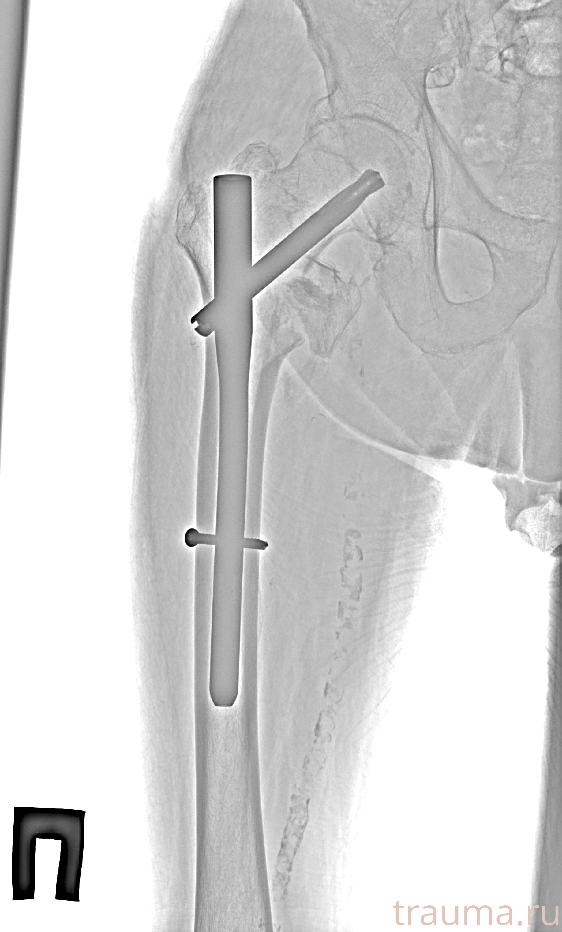 Рентген на дому: по вашему адресу приезжает врач-рентгенолог, травматолог-ортопед с мобильным рентгеновским аппаратом, проводит диагностику травмы или заболевания, делает необходимые рентгенограммы, дает рекомендации по дальнейшему лечению. Получить качественные снимки в домашних условиях возможно благодаря уникальной методике, разработанной МосРентген Центром для института  Склифосовского