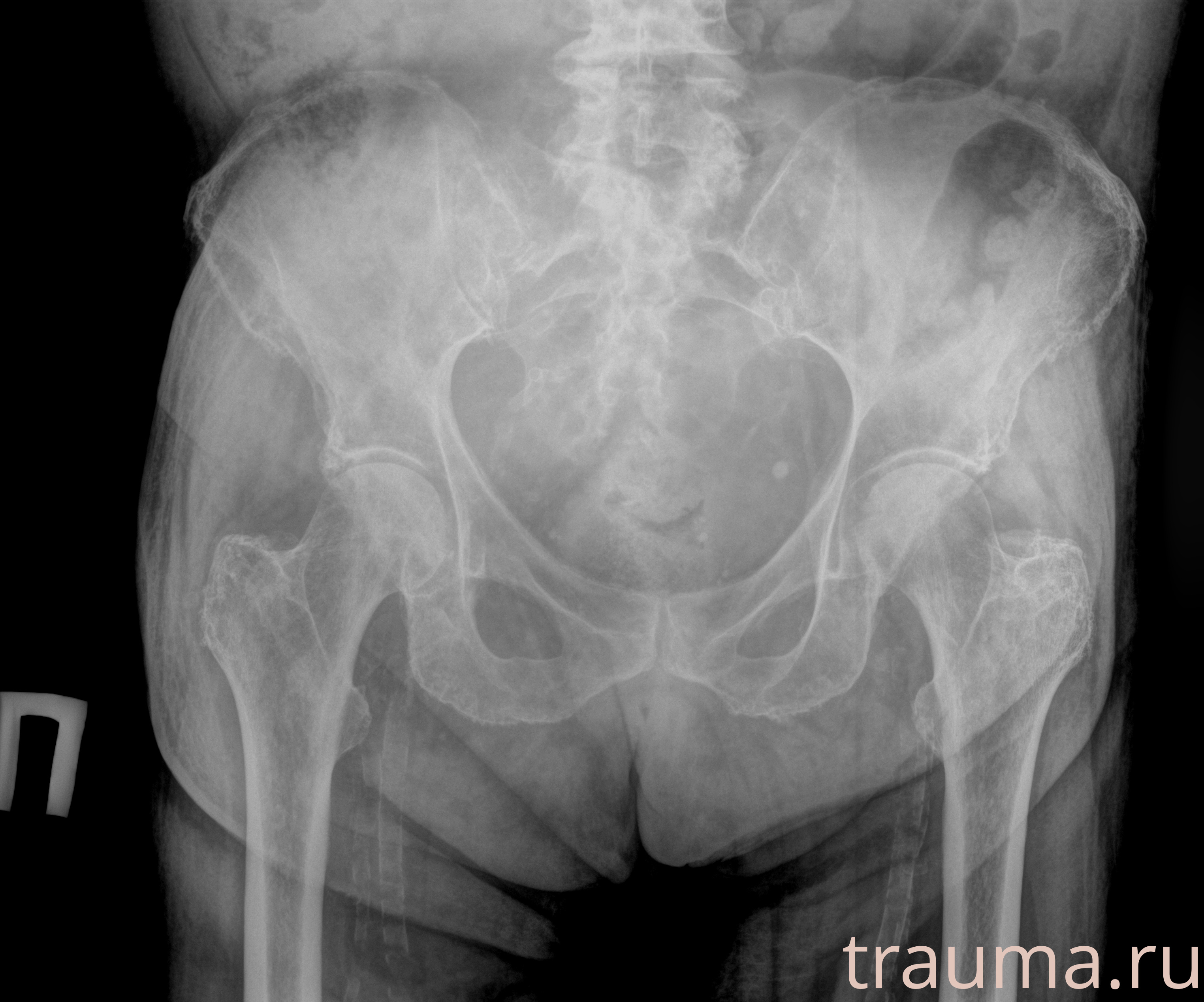 Рентген на дому: по вашему адресу приезжает врач-рентгенолог, травматолог-ортопед с мобильным рентгеновским аппаратом, проводит диагностику травмы или заболевания, делает необходимые рентгенограммы, дает рекомендации по дальнейшему лечению. Получить качественные снимки в домашних условиях возможно благодаря уникальной методике, разработанной МосРентген Центром для института  Склифосовского