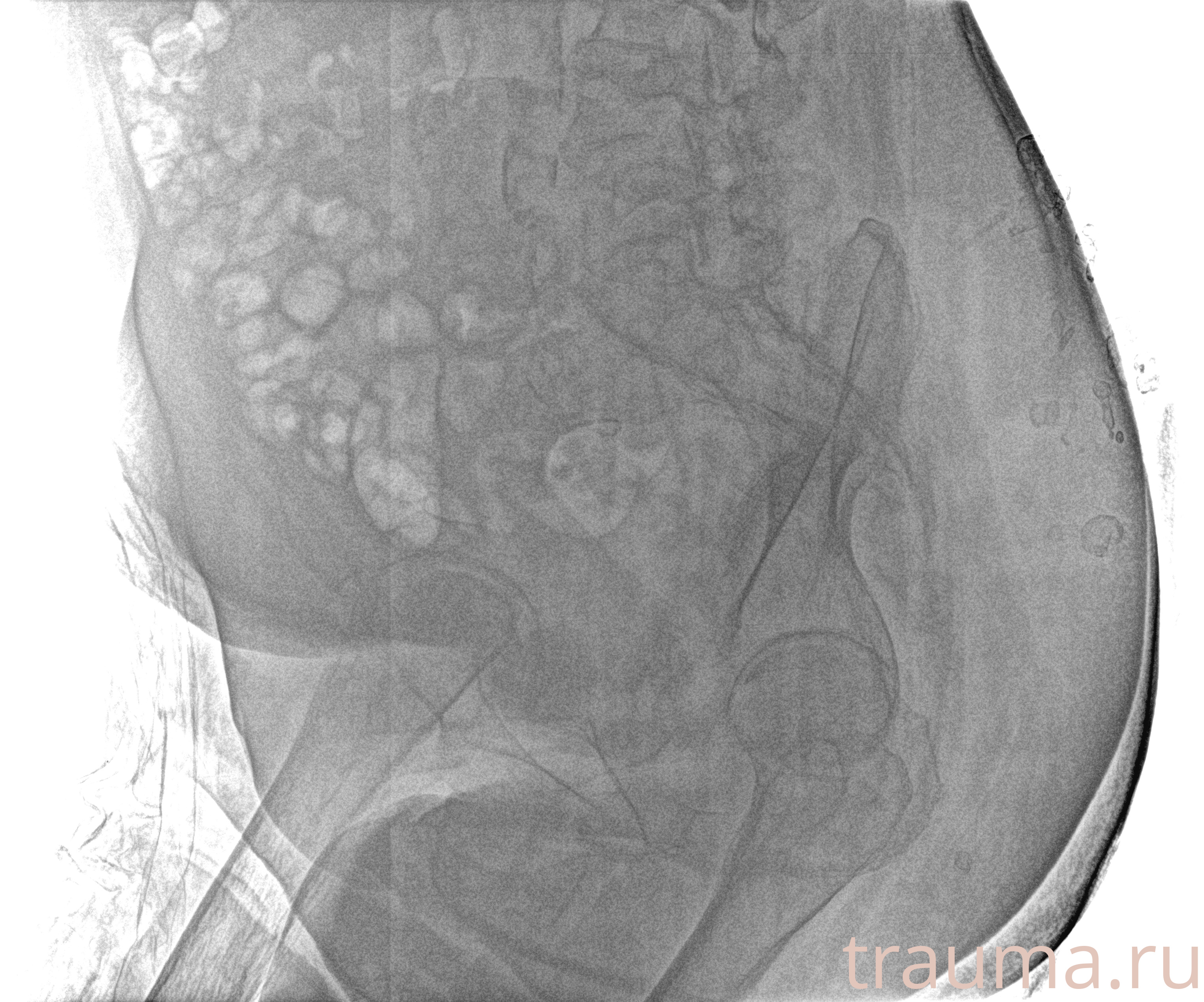 Рентген на дому: по вашему адресу приезжает врач-рентгенолог, травматолог-ортопед с мобильным рентгеновским аппаратом, проводит диагностику травмы или заболевания, делает необходимые рентгенограммы, дает рекомендации по дальнейшему лечению. Получить качественные снимки в домашних условиях возможно благодаря уникальной методике, разработанной МосРентген Центром для института  Склифосовского