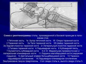 Рентгенодиагностика различных типов плоскостопия у детей и подростков