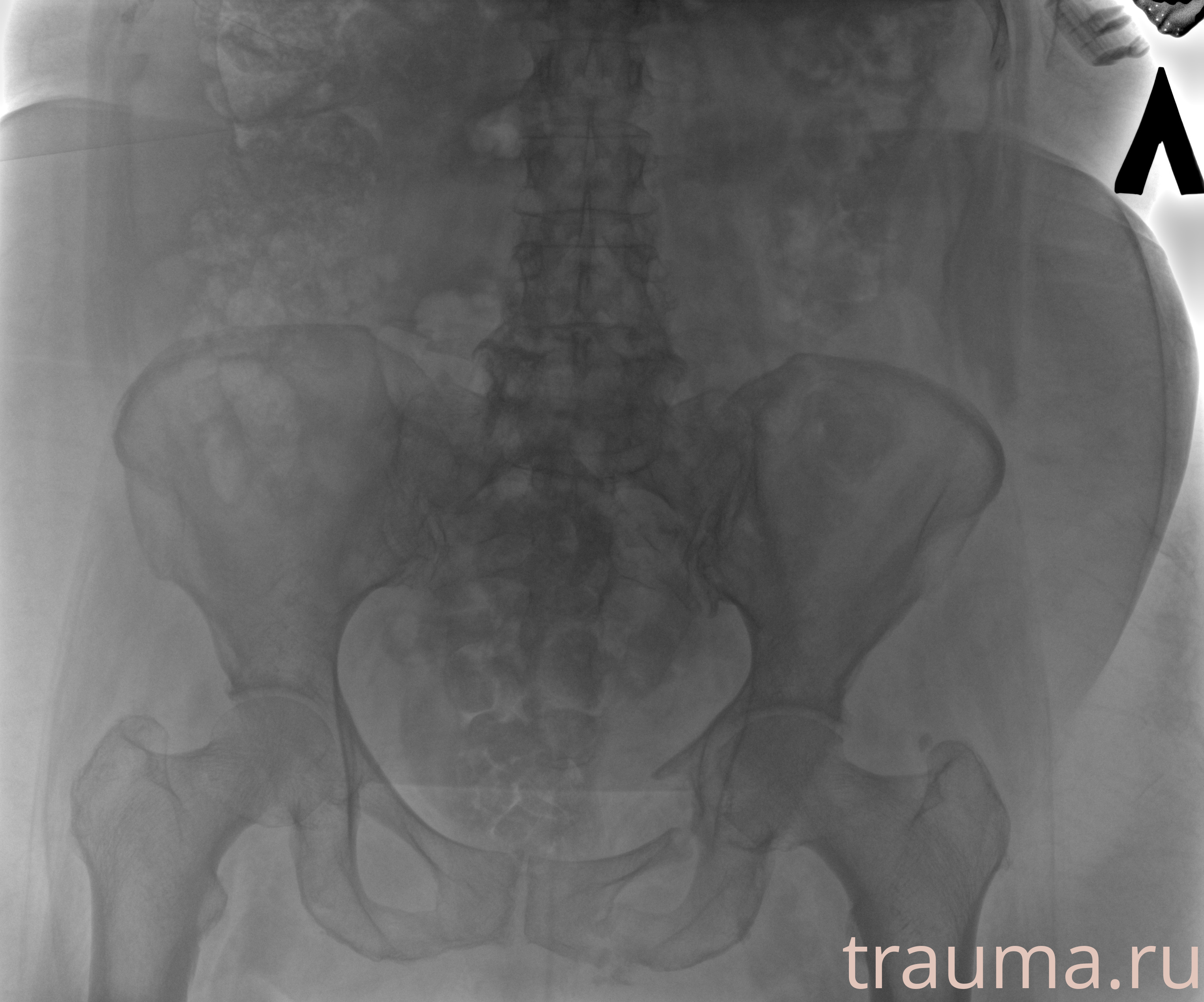 Рентген на дому: по вашему адресу приезжает врач-рентгенолог, травматолог-ортопед с мобильным рентгеновским аппаратом, проводит диагностику травмы или заболевания, делает необходимые рентгенограммы, дает рекомендации по дальнейшему лечению. Получить качественные снимки в домашних условиях возможно благодаря уникальной методике, разработанной МосРентген Центром для института  Склифосовского