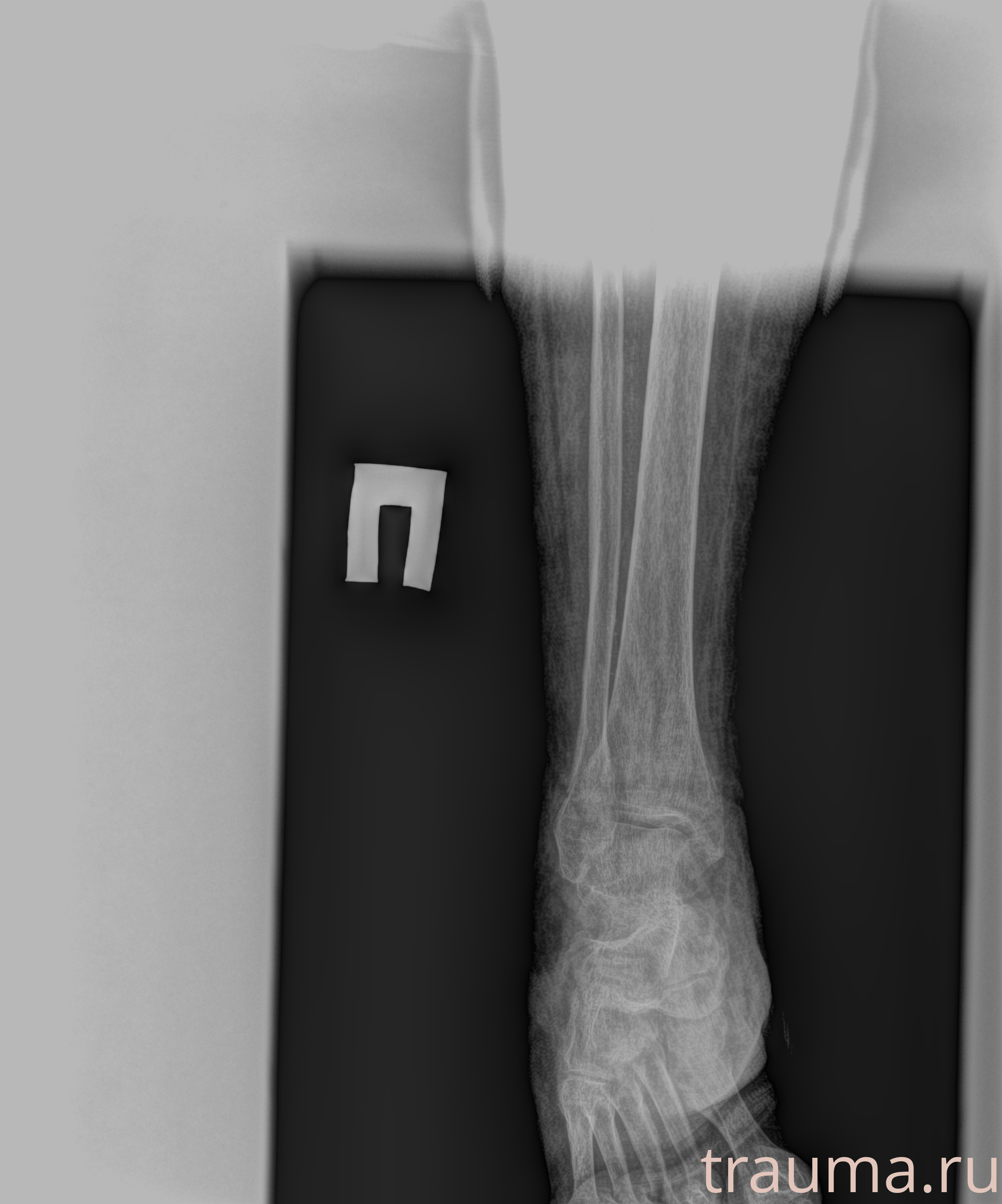 Рентген на дому: по вашему адресу приезжает врач-рентгенолог, травматолог-ортопед с мобильным рентгеновским аппаратом, проводит диагностику травмы или заболевания, делает необходимые рентгенограммы, дает рекомендации по дальнейшему лечению. Получить качественные снимки в домашних условиях возможно благодаря уникальной методике, разработанной МосРентген Центром для института  Склифосовского