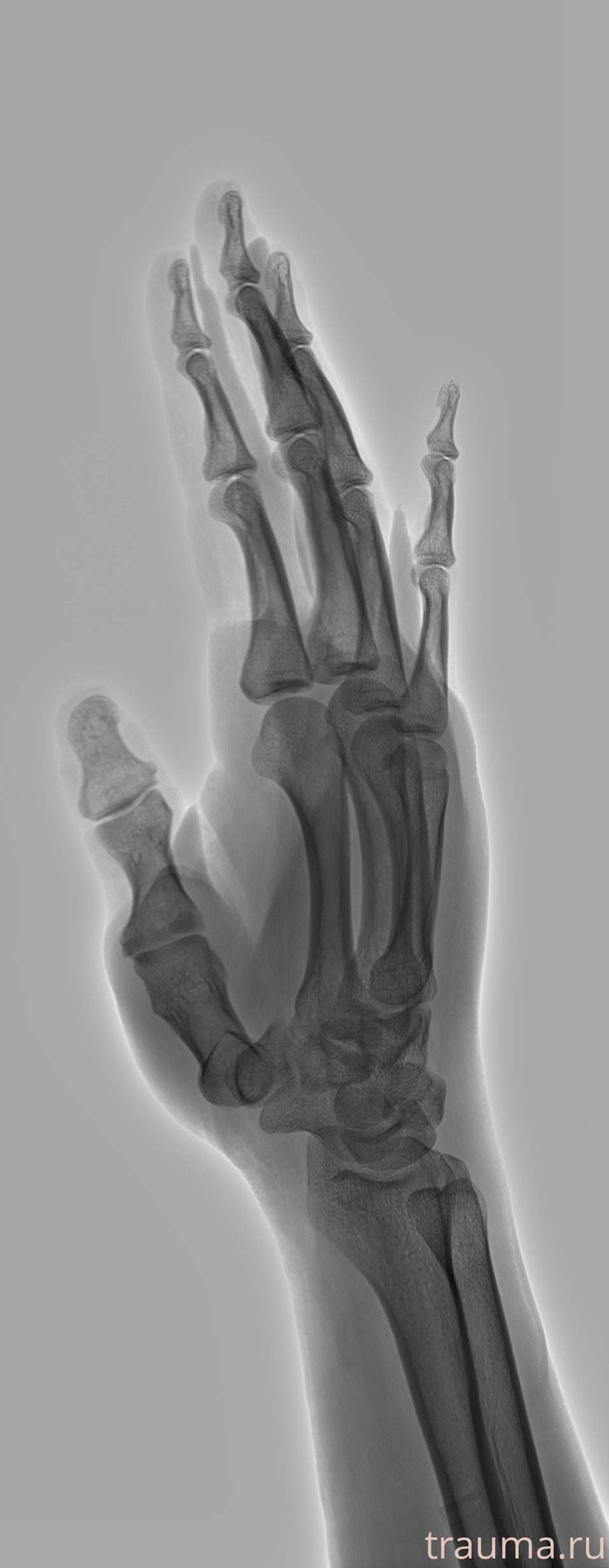 Рентген на дому: по вашему адресу приезжает врач-рентгенолог, травматолог-ортопед с мобильным рентгеновским аппаратом, проводит диагностику травмы или заболевания, делает необходимые рентгенограммы, дает рекомендации по дальнейшему лечению. Получить качественные снимки в домашних условиях возможно благодаря уникальной методике, разработанной МосРентген Центром для института  Склифосовского