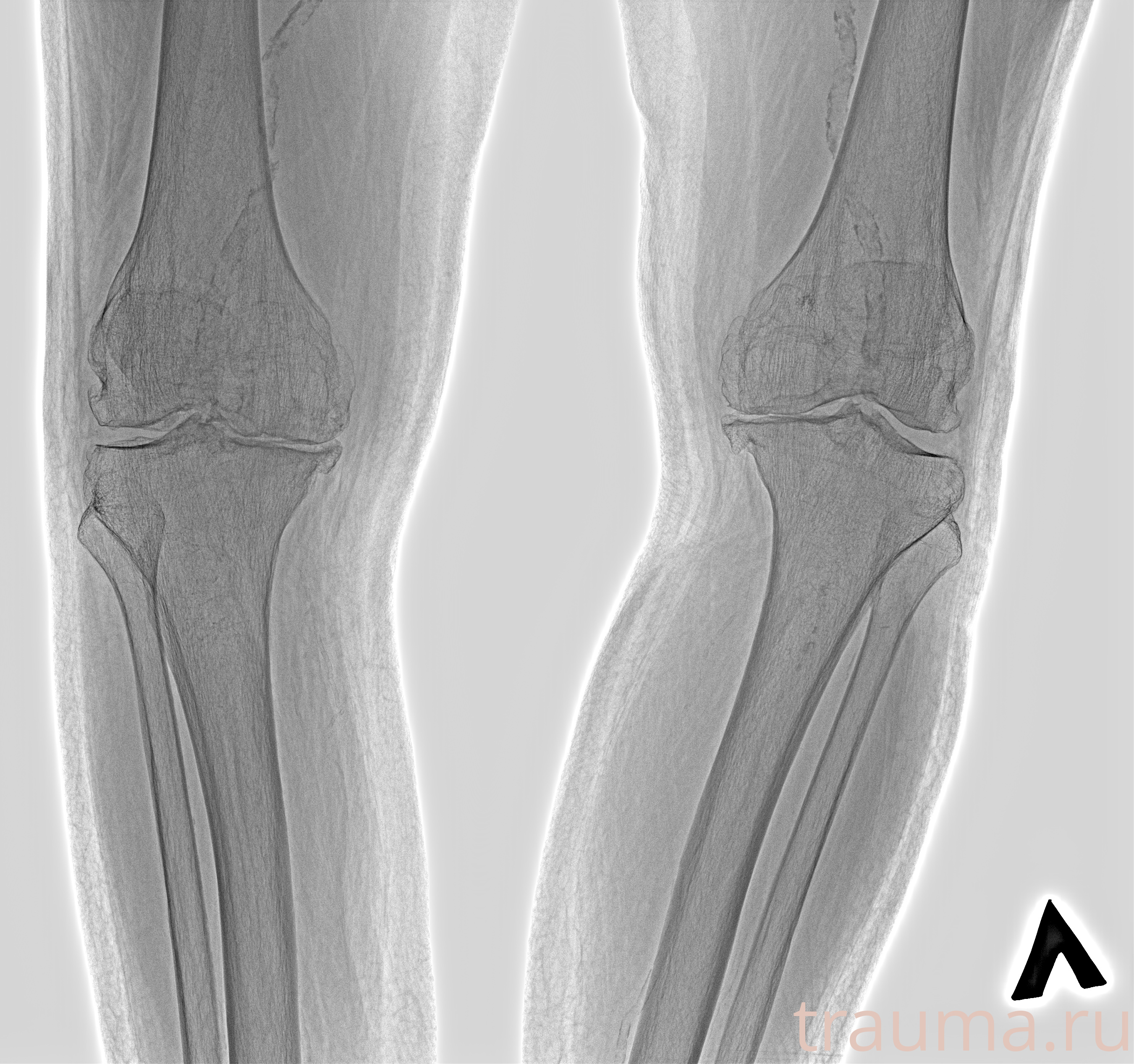 Рентген на дому: по вашему адресу приезжает врач-рентгенолог, травматолог-ортопед с мобильным рентгеновским аппаратом, проводит диагностику травмы или заболевания, делает необходимые рентгенограммы, дает рекомендации по дальнейшему лечению. Получить качественные снимки в домашних условиях возможно благодаря уникальной методике, разработанной МосРентген Центром для института  Склифосовского