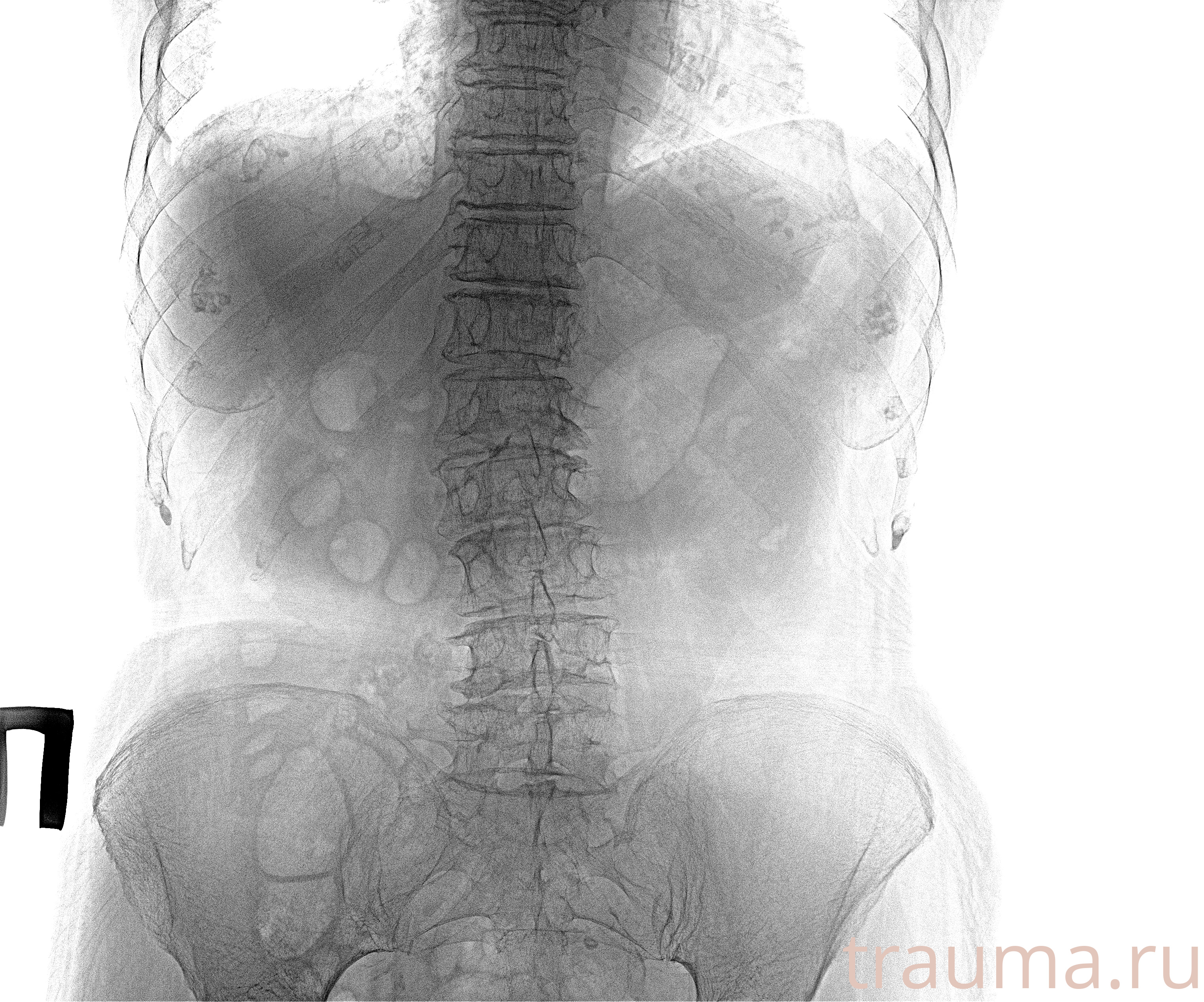 Рентген на дому: по вашему адресу приезжает врач-рентгенолог, травматолог-ортопед с мобильным рентгеновским аппаратом, проводит диагностику травмы или заболевания, делает необходимые рентгенограммы, дает рекомендации по дальнейшему лечению. Получить качественные снимки в домашних условиях возможно благодаря уникальной методике, разработанной МосРентген Центром для института  Склифосовского