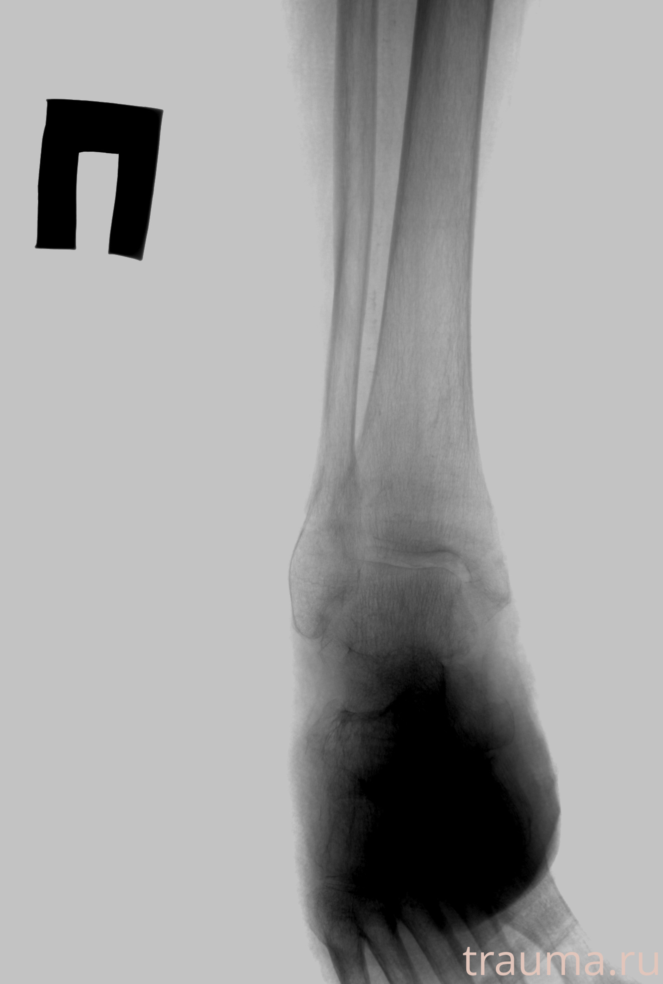 Рентген на дому: по вашему адресу приезжает врач-рентгенолог, травматолог-ортопед с мобильным рентгеновским аппаратом, проводит диагностику травмы или заболевания, делает необходимые рентгенограммы, дает рекомендации по дальнейшему лечению. Получить качественные снимки в домашних условиях возможно благодаря уникальной методике, разработанной МосРентген Центром для института  Склифосовского