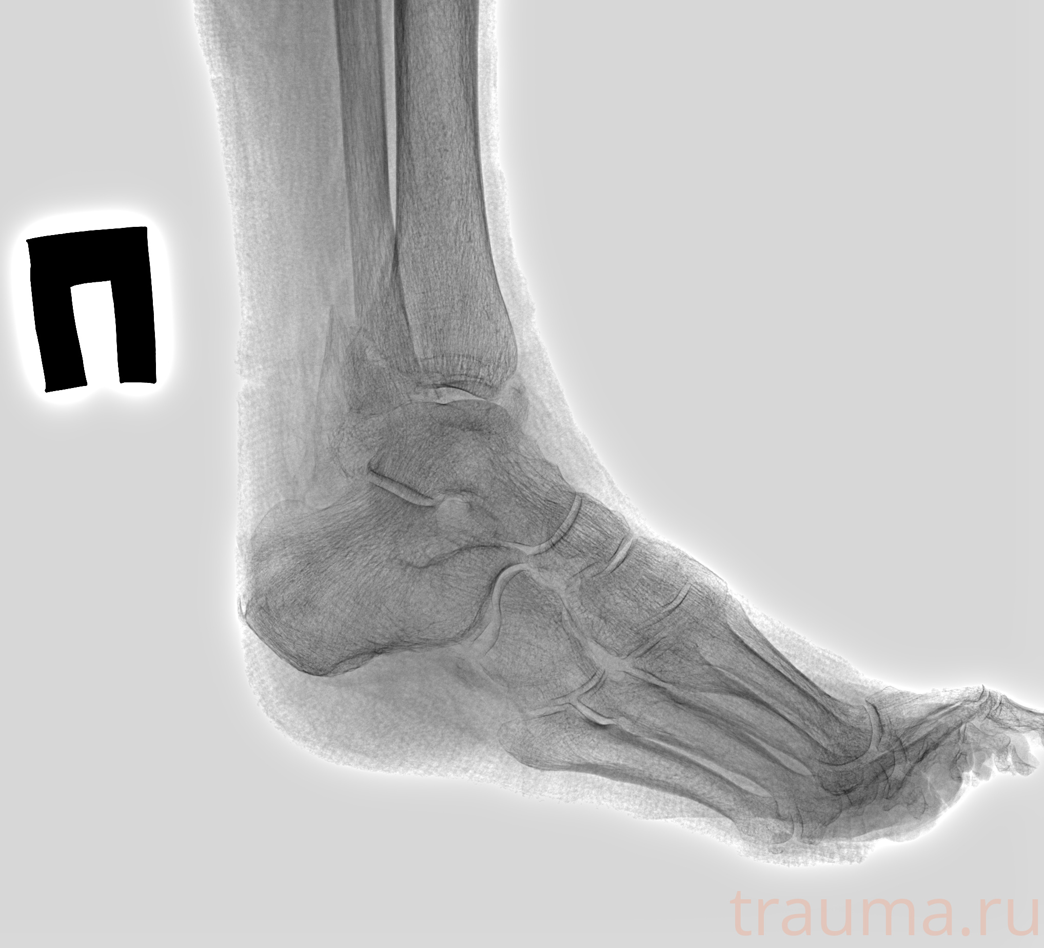 Рентген на дому: по вашему адресу приезжает врач-рентгенолог, травматолог-ортопед с мобильным рентгеновским аппаратом, проводит диагностику травмы или заболевания, делает необходимые рентгенограммы, дает рекомендации по дальнейшему лечению. Получить качественные снимки в домашних условиях возможно благодаря уникальной методике, разработанной МосРентген Центром для института  Склифосовского