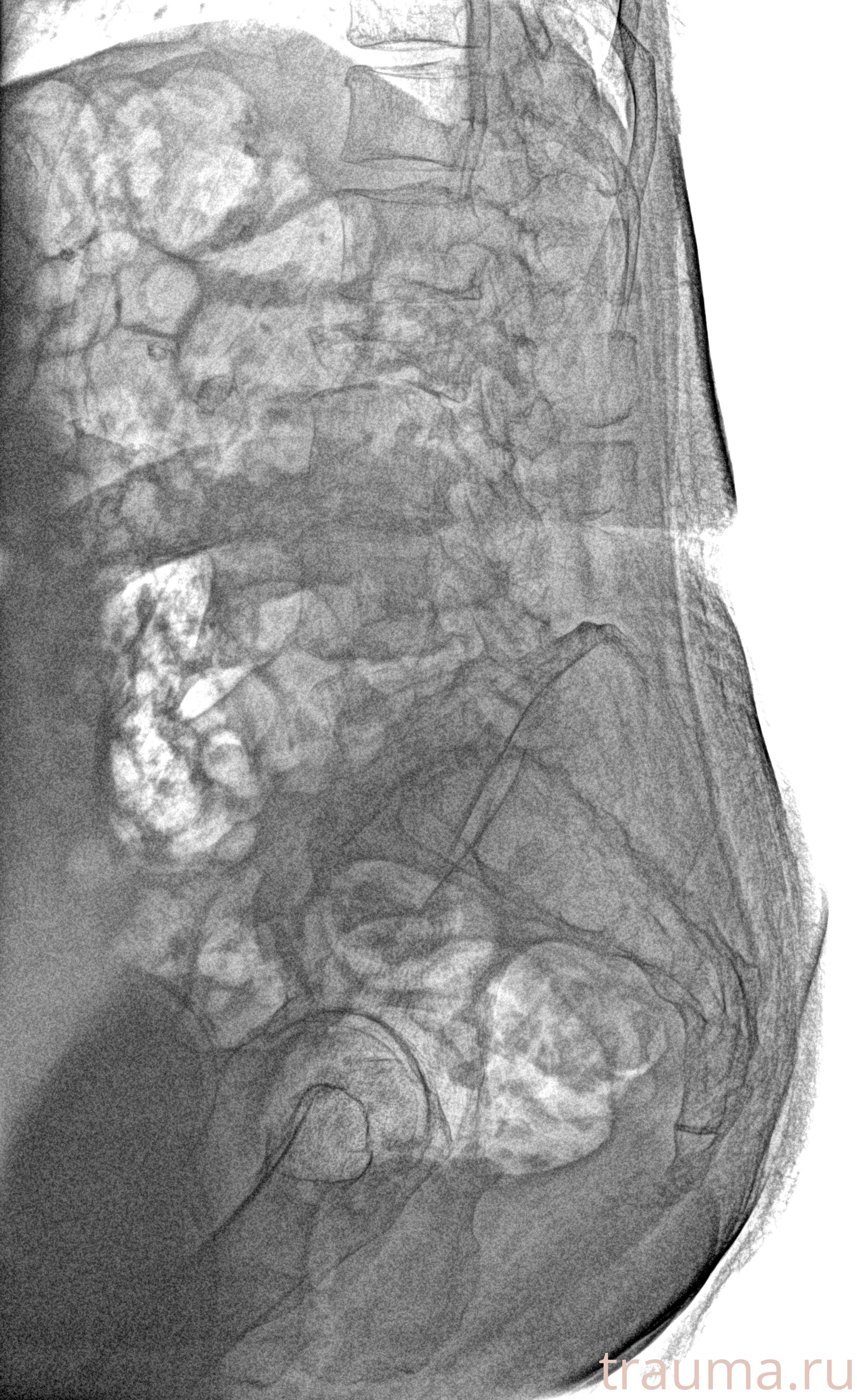 Рентген на дому: по вашему адресу приезжает врач-рентгенолог, травматолог-ортопед с мобильным рентгеновским аппаратом, проводит диагностику травмы или заболевания, делает необходимые рентгенограммы, дает рекомендации по дальнейшему лечению. Получить качественные снимки в домашних условиях возможно благодаря уникальной методике, разработанной МосРентген Центром для института  Склифосовского