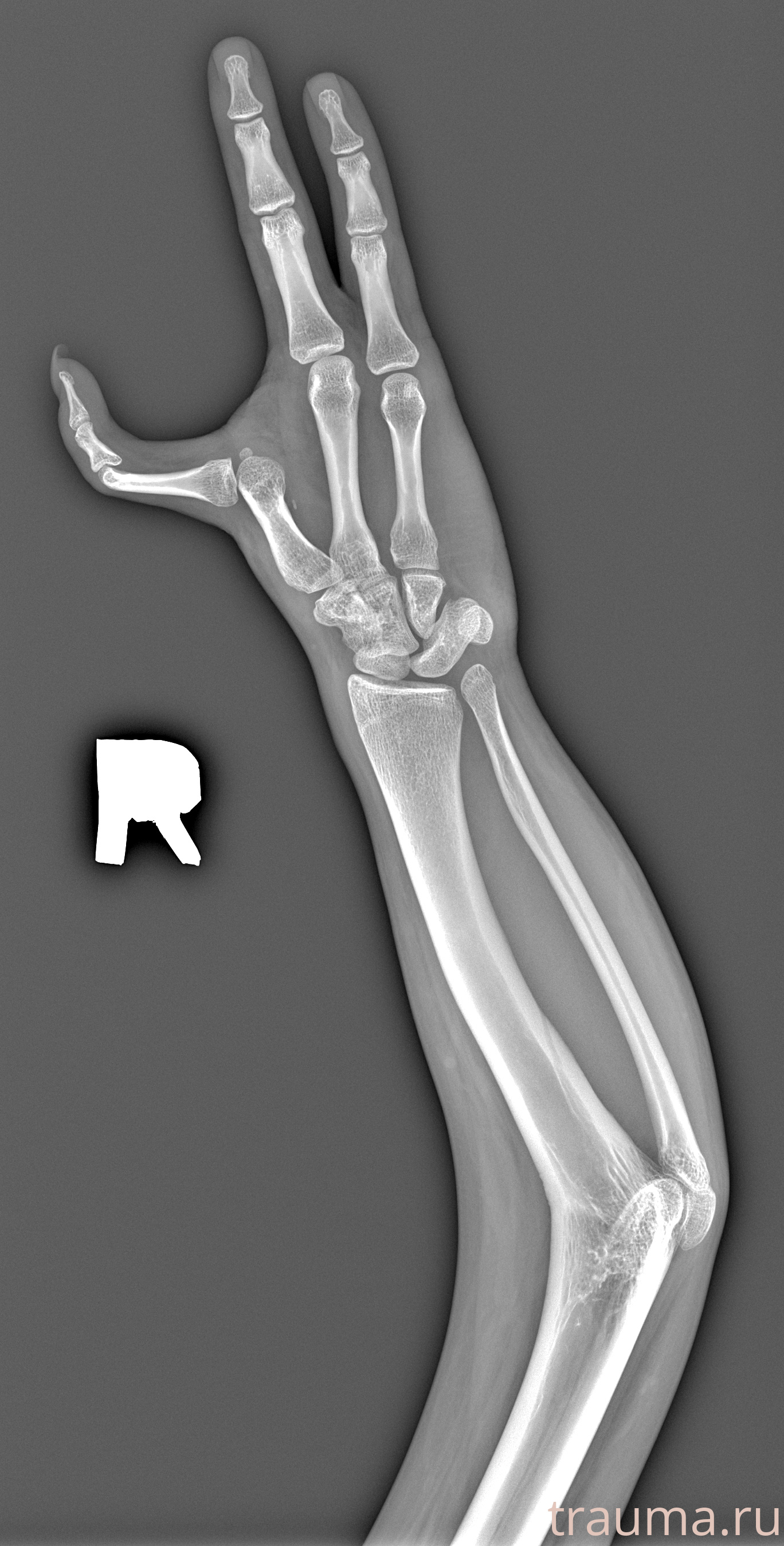 Рентген на дому: по вашему адресу приезжает врач-рентгенолог, травматолог-ортопед с мобильным рентгеновским аппаратом, проводит диагностику травмы или заболевания, делает необходимые рентгенограммы, дает рекомендации по дальнейшему лечению. Получить качественные снимки в домашних условиях возможно благодаря уникальной методике, разработанной МосРентген Центром для института  Склифосовского