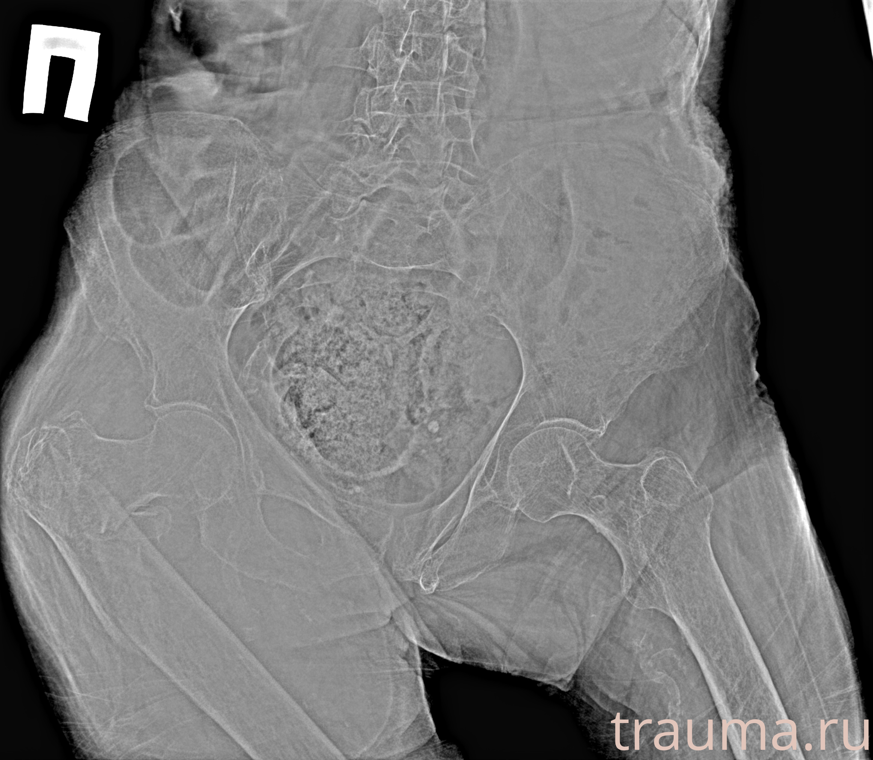 Рентген на дому: по вашему адресу приезжает врач-рентгенолог, травматолог-ортопед с мобильным рентгеновским аппаратом, проводит диагностику травмы или заболевания, делает необходимые рентгенограммы, дает рекомендации по дальнейшему лечению. Получить качественные снимки в домашних условиях возможно благодаря уникальной методике, разработанной МосРентген Центром для института  Склифосовского