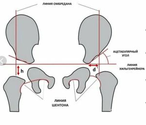 Результаты хирургического лечения пациентов с переломами вертлужной впадины и квадрилатеральной поверхности Результаты хирургического лечения пациентов с переломами вертлужной впадины и квадрилатеральной поверхности