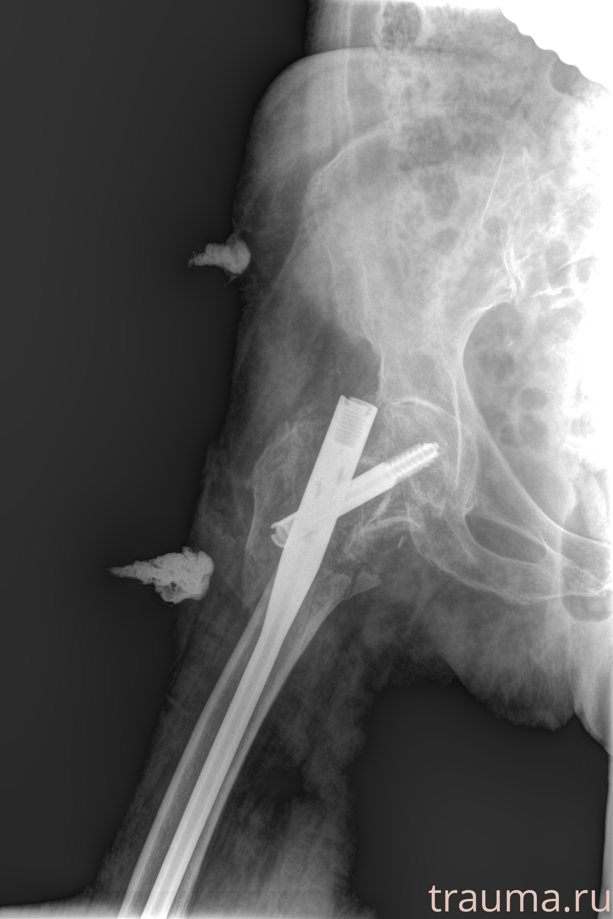 Рентген на дому: по вашему адресу приезжает врач-рентгенолог, травматолог-ортопед с мобильным рентгеновским аппаратом, проводит диагностику травмы или заболевания, делает необходимые рентгенограммы, дает рекомендации по дальнейшему лечению. Получить качественные снимки в домашних условиях возможно благодаря уникальной методике, разработанной МосРентген Центром для института  Склифосовского