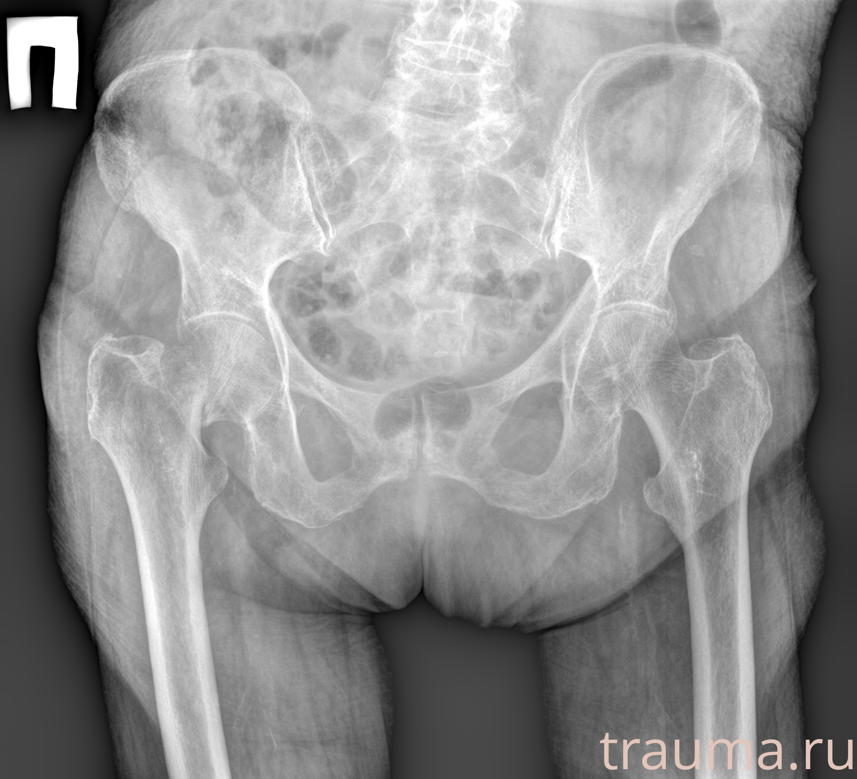 Рентген на дому: по вашему адресу приезжает врач-рентгенолог, травматолог-ортопед с мобильным рентгеновским аппаратом, проводит диагностику травмы или заболевания, делает необходимые рентгенограммы, дает рекомендации по дальнейшему лечению. Получить качественные снимки в домашних условиях возможно благодаря уникальной методике, разработанной МосРентген Центром для института  Склифосовского