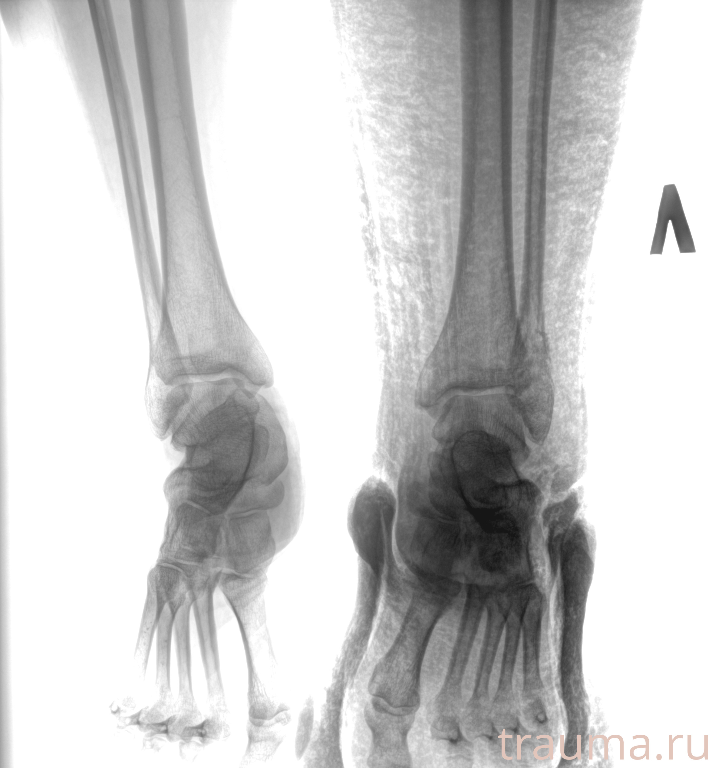 Рентген на дому: по вашему адресу приезжает врач-рентгенолог, травматолог-ортопед с мобильным рентгеновским аппаратом, проводит диагностику травмы или заболевания, делает необходимые рентгенограммы, дает рекомендации по дальнейшему лечению. Получить качественные снимки в домашних условиях возможно благодаря уникальной методике, разработанной МосРентген Центром для института  Склифосовского