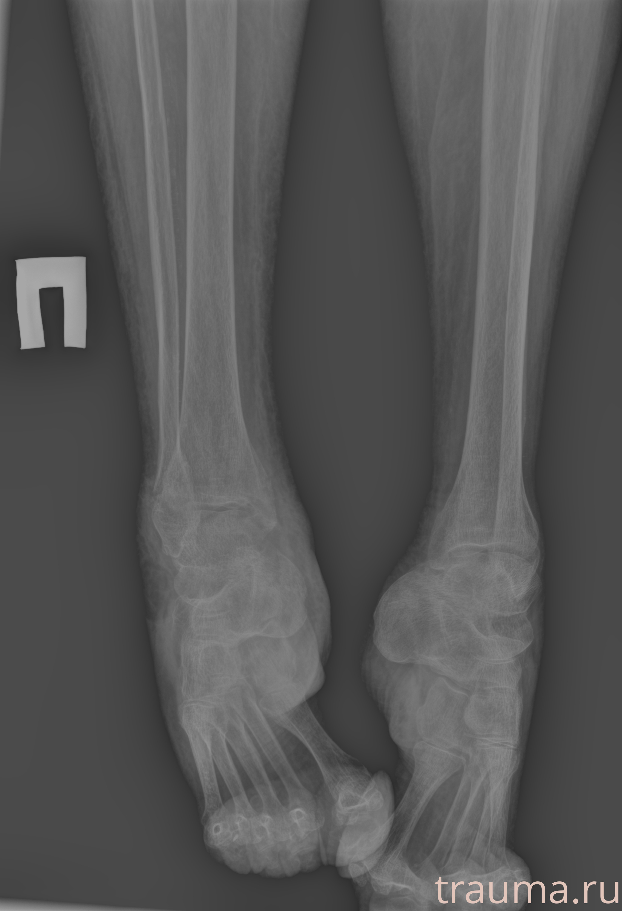 Рентген на дому: по вашему адресу приезжает врач-рентгенолог, травматолог-ортопед с мобильным рентгеновским аппаратом, проводит диагностику травмы или заболевания, делает необходимые рентгенограммы, дает рекомендации по дальнейшему лечению. Получить качественные снимки в домашних условиях возможно благодаря уникальной методике, разработанной МосРентген Центром для института  Склифосовского