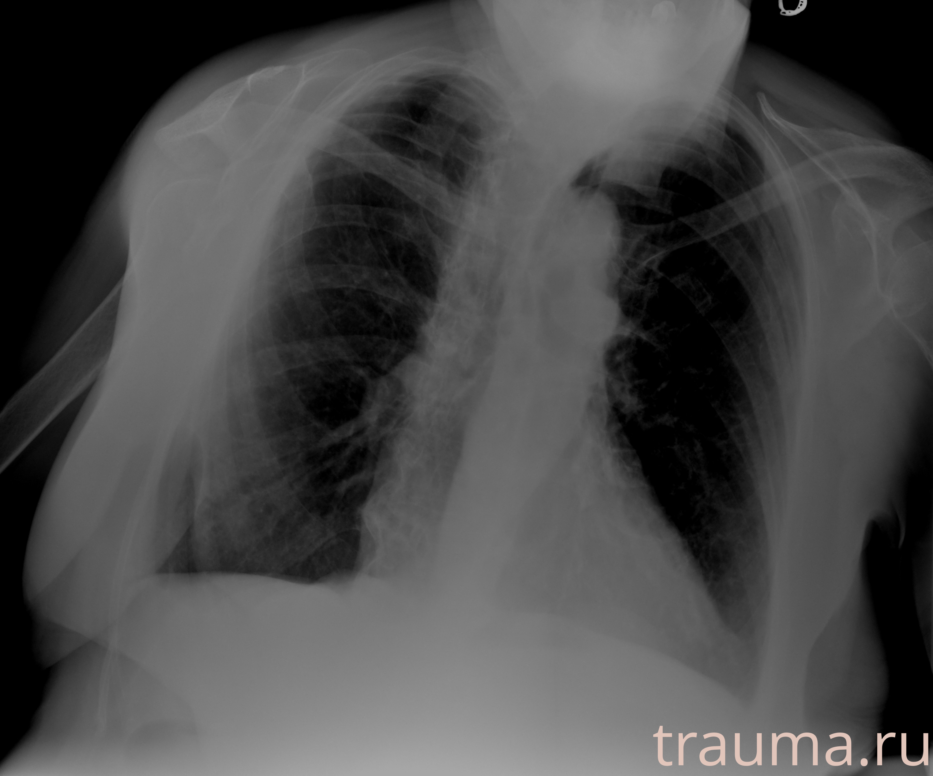 Рентген на дому: по вашему адресу приезжает врач-рентгенолог, травматолог-ортопед с мобильным рентгеновским аппаратом, проводит диагностику травмы или заболевания, делает необходимые рентгенограммы, дает рекомендации по дальнейшему лечению. Получить качественные снимки в домашних условиях возможно благодаря уникальной методике, разработанной МосРентген Центром для института  Склифосовского
