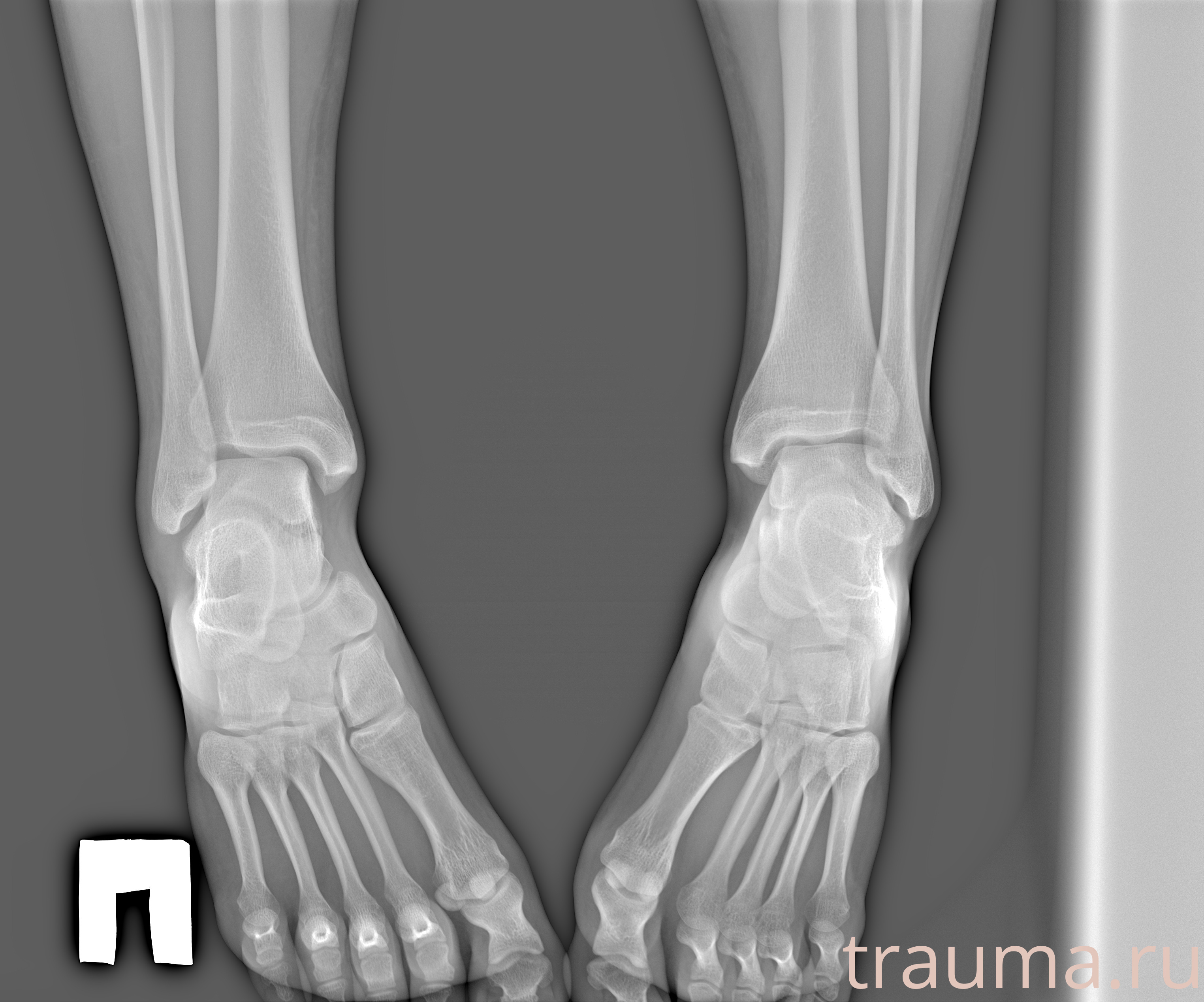 Рентген на дому: по вашему адресу приезжает врач-рентгенолог, травматолог-ортопед с мобильным рентгеновским аппаратом, проводит диагностику травмы или заболевания, делает необходимые рентгенограммы, дает рекомендации по дальнейшему лечению. Получить качественные снимки в домашних условиях возможно благодаря уникальной методике, разработанной МосРентген Центром для института  Склифосовского