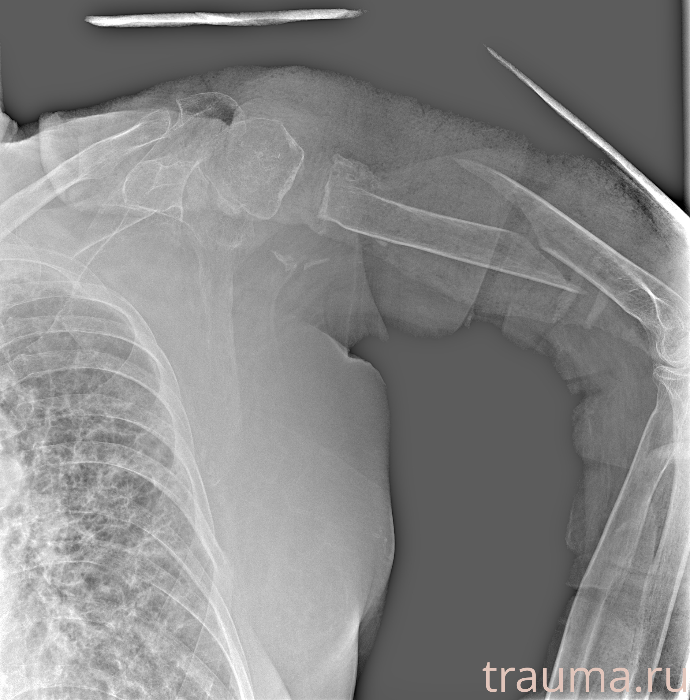 Рентген на дому: по вашему адресу приезжает врач-рентгенолог, травматолог-ортопед с мобильным рентгеновским аппаратом, проводит диагностику травмы или заболевания, делает необходимые рентгенограммы, дает рекомендации по дальнейшему лечению. Получить качественные снимки в домашних условиях возможно благодаря уникальной методике, разработанной МосРентген Центром для института  Склифосовского