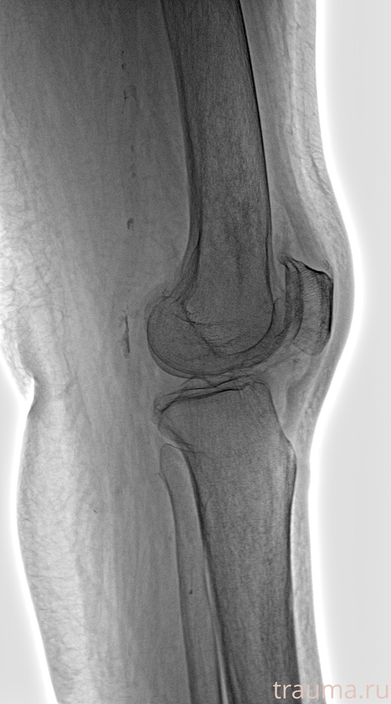 Рентген на дому: по вашему адресу приезжает врач-рентгенолог, травматолог-ортопед с мобильным рентгеновским аппаратом, проводит диагностику травмы или заболевания, делает необходимые рентгенограммы, дает рекомендации по дальнейшему лечению. Получить качественные снимки в домашних условиях возможно благодаря уникальной методике, разработанной МосРентген Центром для института  Склифосовского