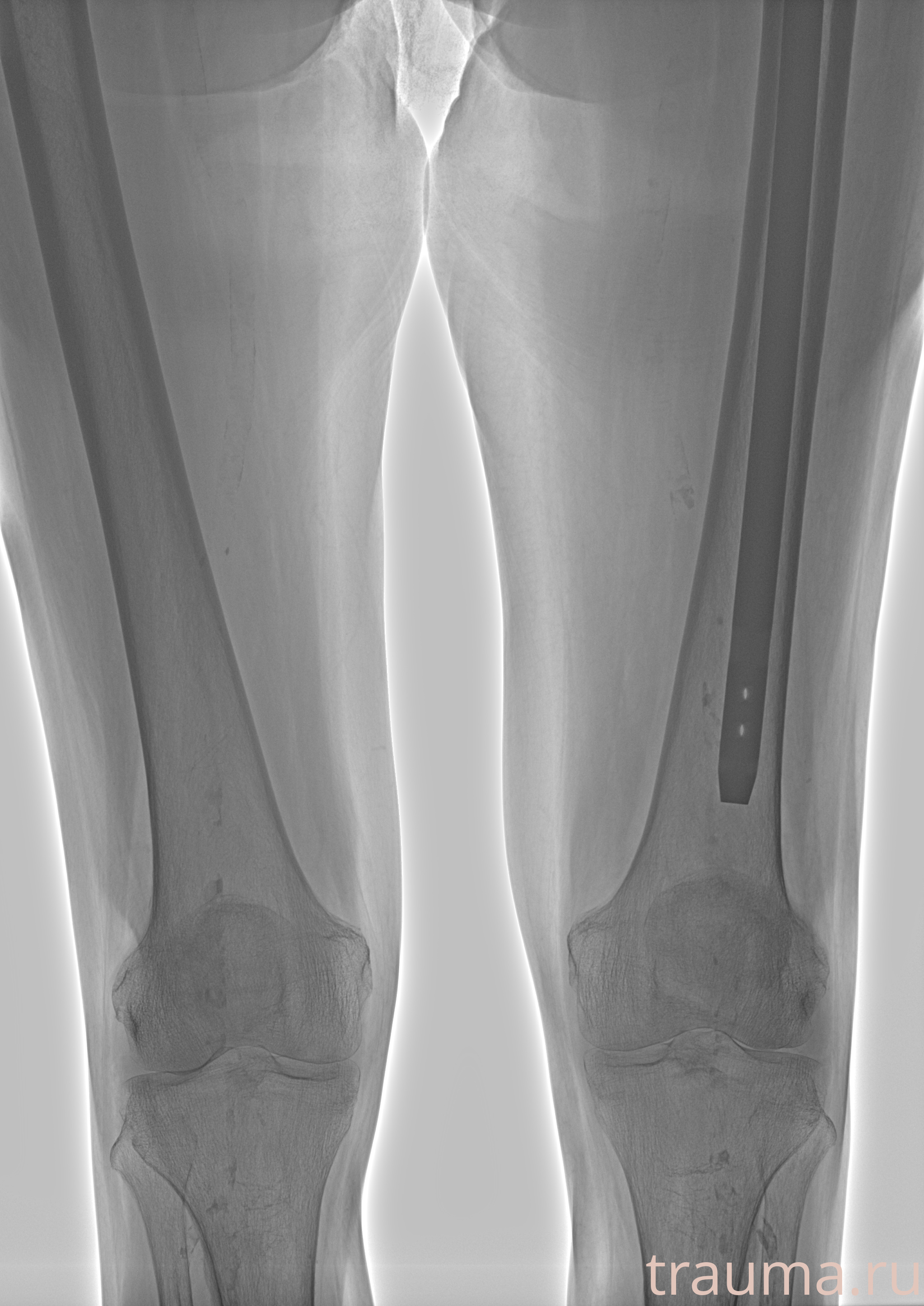 Рентген на дому: по вашему адресу приезжает врач-рентгенолог, травматолог-ортопед с мобильным рентгеновским аппаратом, проводит диагностику травмы или заболевания, делает необходимые рентгенограммы, дает рекомендации по дальнейшему лечению. Получить качественные снимки в домашних условиях возможно благодаря уникальной методике, разработанной МосРентген Центром для института  Склифосовского