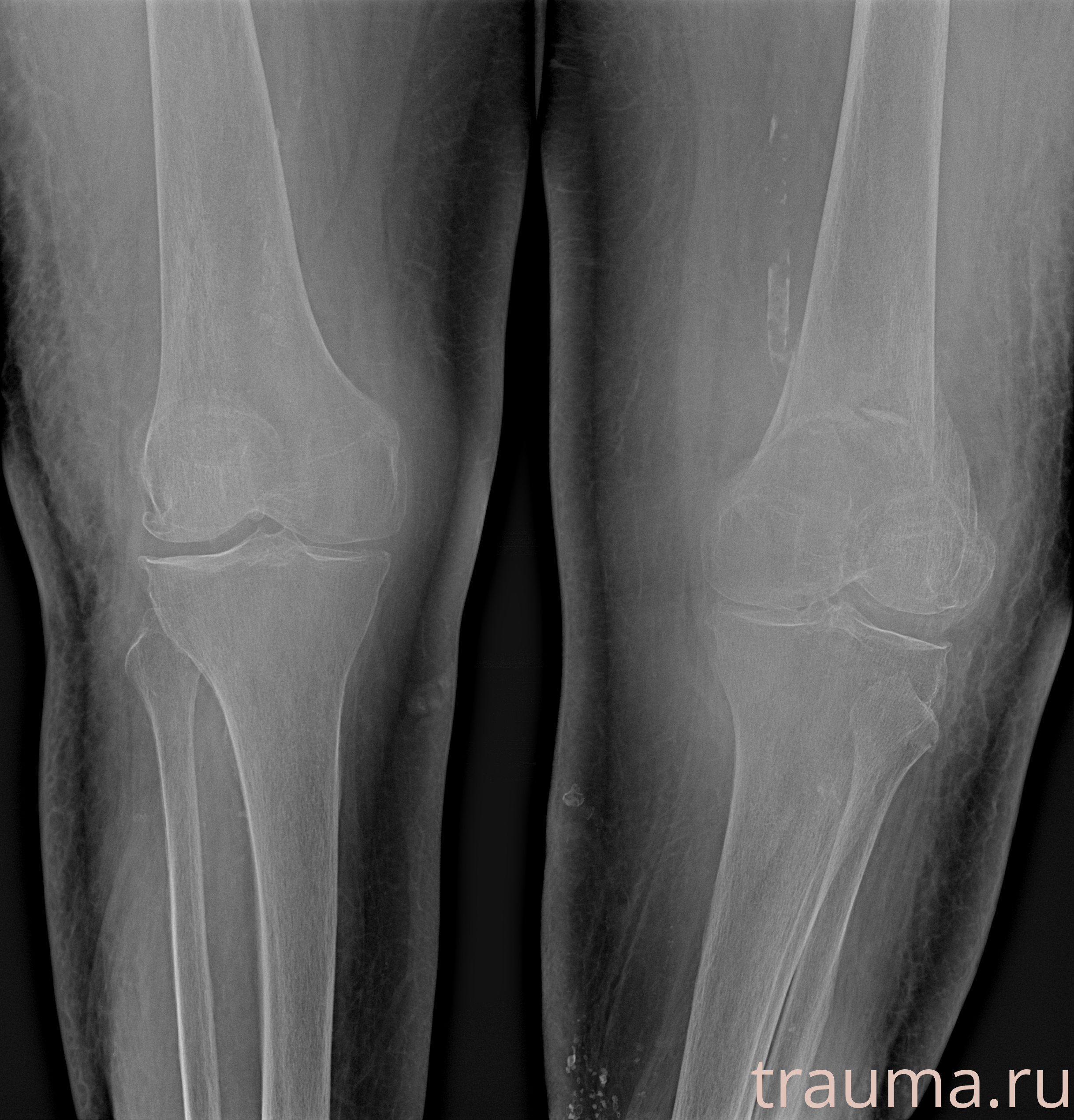 Рентген на дому: по вашему адресу приезжает врач-рентгенолог, травматолог-ортопед с мобильным рентгеновским аппаратом, проводит диагностику травмы или заболевания, делает необходимые рентгенограммы, дает рекомендации по дальнейшему лечению. Получить качественные снимки в домашних условиях возможно благодаря уникальной методике, разработанной МосРентген Центром для института  Склифосовского