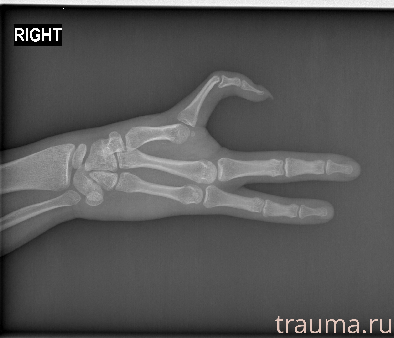 Рентген на дому: по вашему адресу приезжает врач-рентгенолог, травматолог-ортопед с мобильным рентгеновским аппаратом, проводит диагностику травмы или заболевания, делает необходимые рентгенограммы, дает рекомендации по дальнейшему лечению. Получить качественные снимки в домашних условиях возможно благодаря уникальной методике, разработанной МосРентген Центром для института  Склифосовского