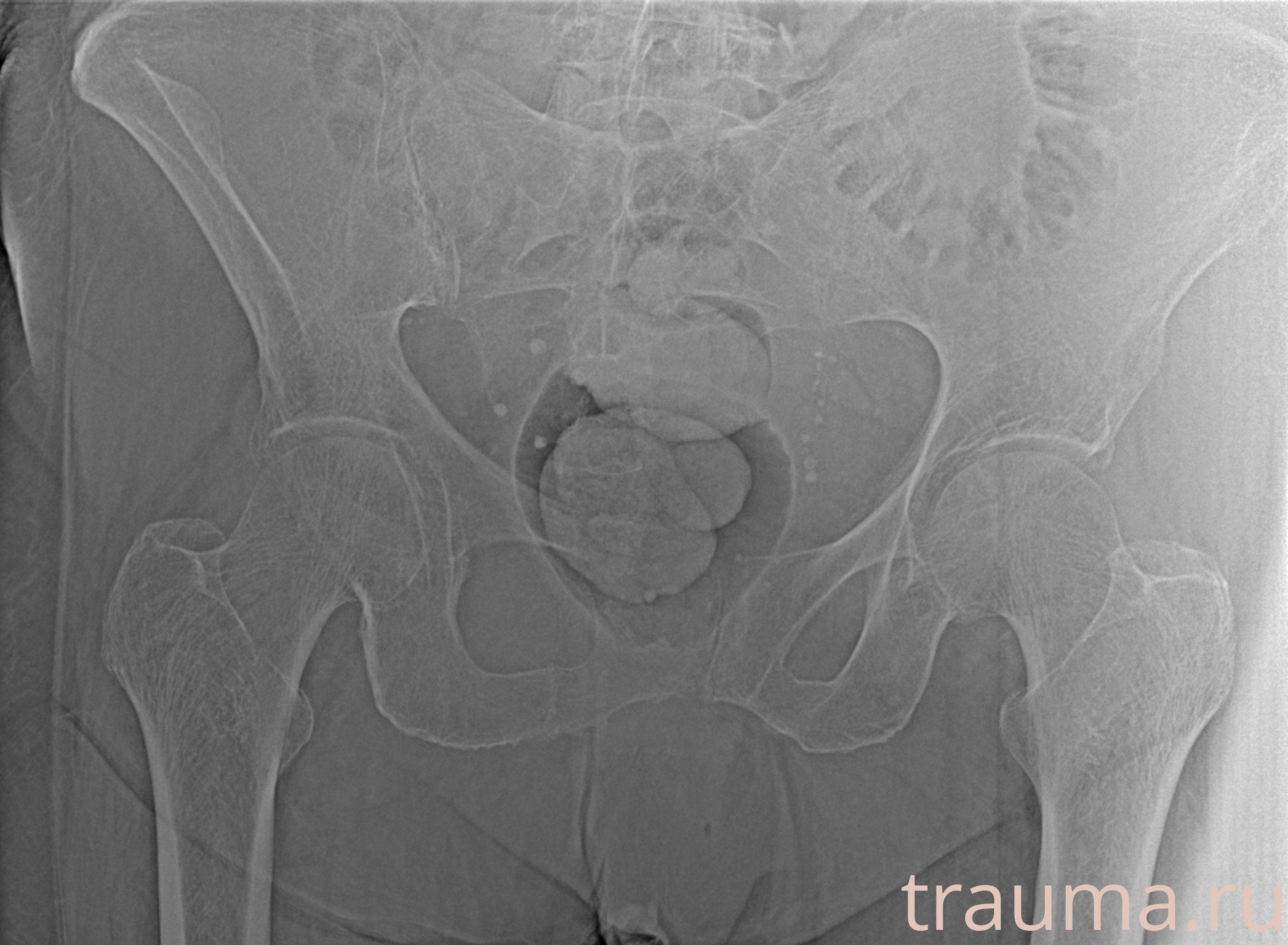 Рентген на дому: по вашему адресу приезжает врач-рентгенолог, травматолог-ортопед с мобильным рентгеновским аппаратом, проводит диагностику травмы или заболевания, делает необходимые рентгенограммы, дает рекомендации по дальнейшему лечению. Получить качественные снимки в домашних условиях возможно благодаря уникальной методике, разработанной МосРентген Центром для института  Склифосовского