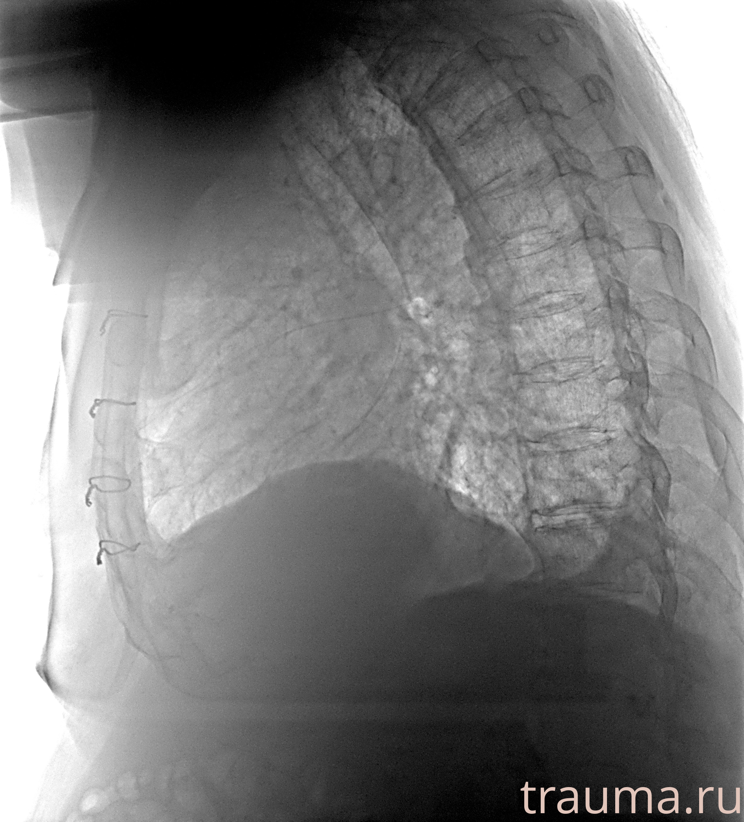 Рентген на дому: по вашему адресу приезжает врач-рентгенолог, травматолог-ортопед с мобильным рентгеновским аппаратом, проводит диагностику травмы или заболевания, делает необходимые рентгенограммы, дает рекомендации по дальнейшему лечению. Получить качественные снимки в домашних условиях возможно благодаря уникальной методике, разработанной МосРентген Центром для института  Склифосовского