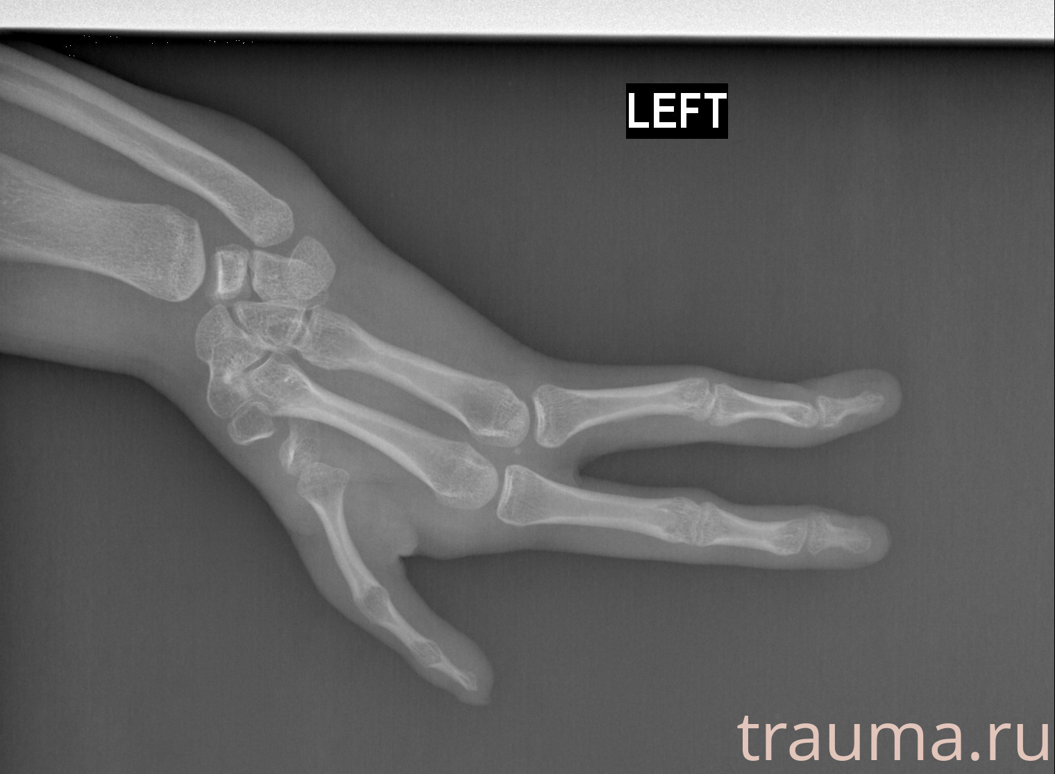 Рентген на дому: по вашему адресу приезжает врач-рентгенолог, травматолог-ортопед с мобильным рентгеновским аппаратом, проводит диагностику травмы или заболевания, делает необходимые рентгенограммы, дает рекомендации по дальнейшему лечению. Получить качественные снимки в домашних условиях возможно благодаря уникальной методике, разработанной МосРентген Центром для института  Склифосовского