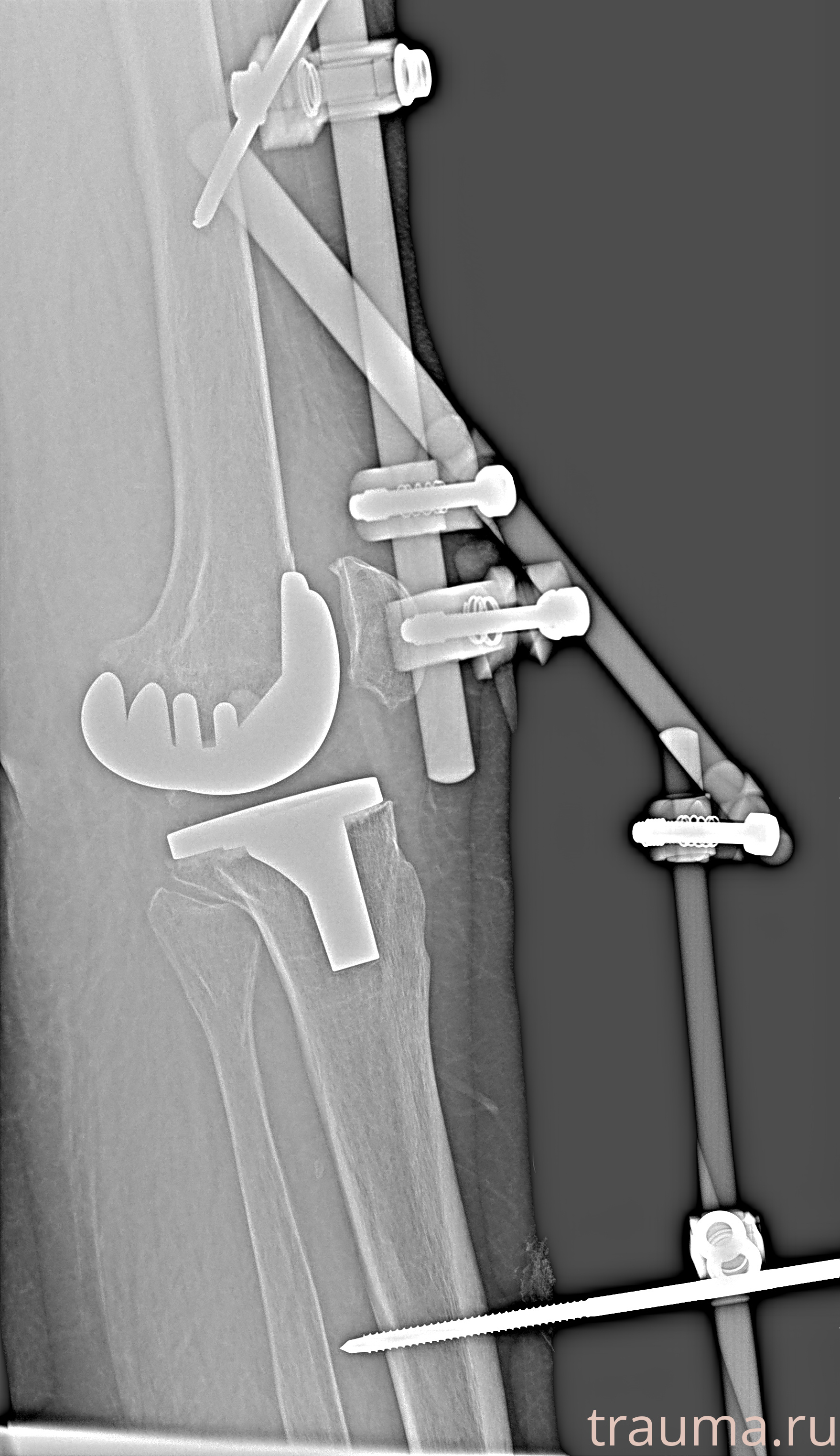 Рентген на дому: по вашему адресу приезжает врач-рентгенолог, травматолог-ортопед с мобильным рентгеновским аппаратом, проводит диагностику травмы или заболевания, делает необходимые рентгенограммы, дает рекомендации по дальнейшему лечению. Получить качественные снимки в домашних условиях возможно благодаря уникальной методике, разработанной МосРентген Центром для института  Склифосовского