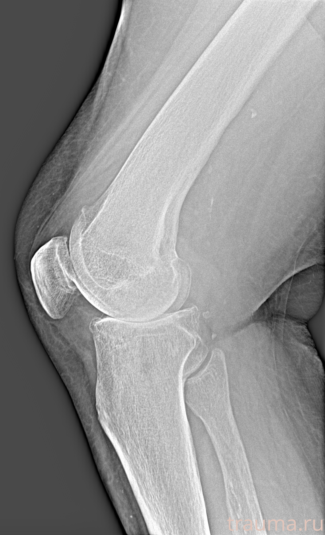 Рентген на дому: по вашему адресу приезжает врач-рентгенолог, травматолог-ортопед с мобильным рентгеновским аппаратом, проводит диагностику травмы или заболевания, делает необходимые рентгенограммы, дает рекомендации по дальнейшему лечению. Получить качественные снимки в домашних условиях возможно благодаря уникальной методике, разработанной МосРентген Центром для института  Склифосовского