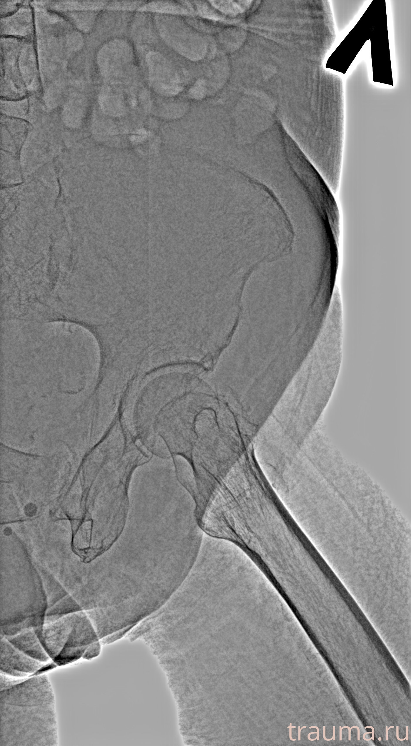 Рентген на дому: по вашему адресу приезжает врач-рентгенолог, травматолог-ортопед с мобильным рентгеновским аппаратом, проводит диагностику травмы или заболевания, делает необходимые рентгенограммы, дает рекомендации по дальнейшему лечению. Получить качественные снимки в домашних условиях возможно благодаря уникальной методике, разработанной МосРентген Центром для института  Склифосовского