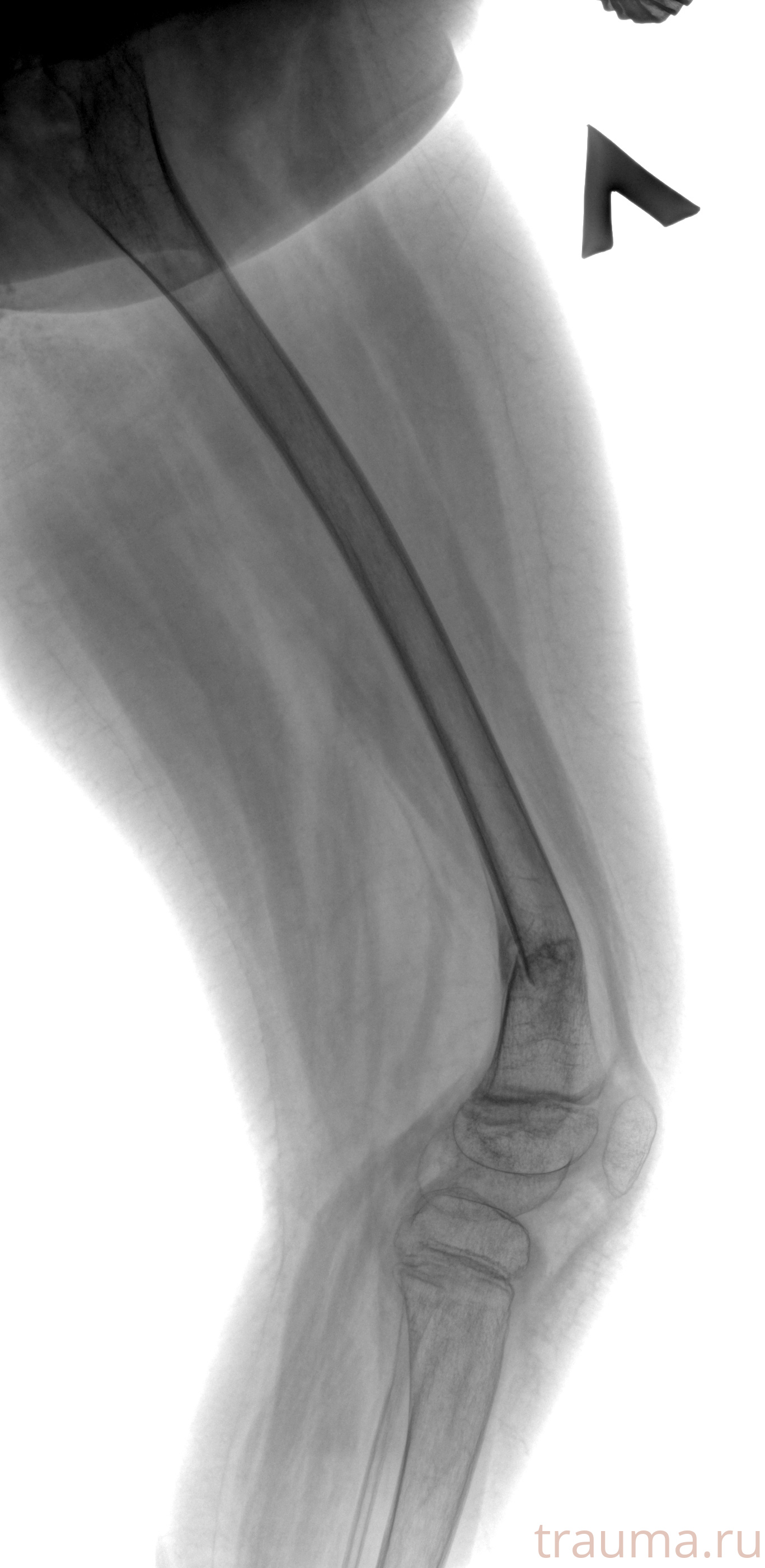 Рентген на дому: по вашему адресу приезжает врач-рентгенолог, травматолог-ортопед с мобильным рентгеновским аппаратом, проводит диагностику травмы или заболевания, делает необходимые рентгенограммы, дает рекомендации по дальнейшему лечению. Получить качественные снимки в домашних условиях возможно благодаря уникальной методике, разработанной МосРентген Центром для института  Склифосовского