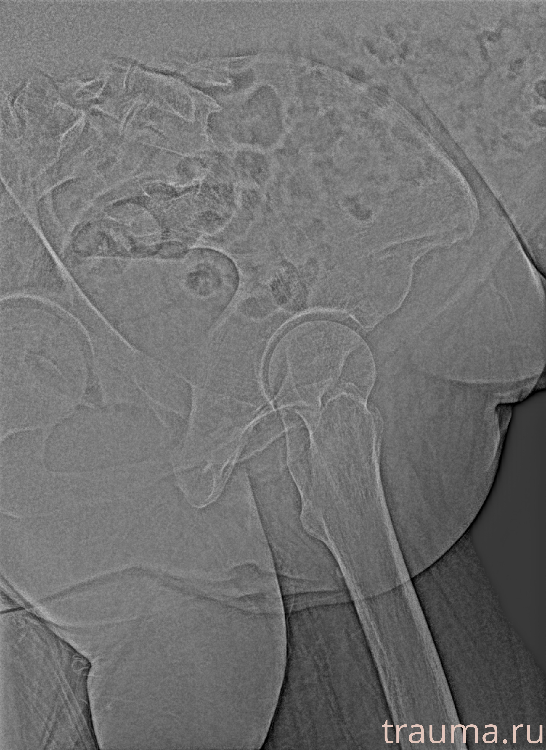 Рентген на дому: по вашему адресу приезжает врач-рентгенолог, травматолог-ортопед с мобильным рентгеновским аппаратом, проводит диагностику травмы или заболевания, делает необходимые рентгенограммы, дает рекомендации по дальнейшему лечению. Получить качественные снимки в домашних условиях возможно благодаря уникальной методике, разработанной МосРентген Центром для института  Склифосовского