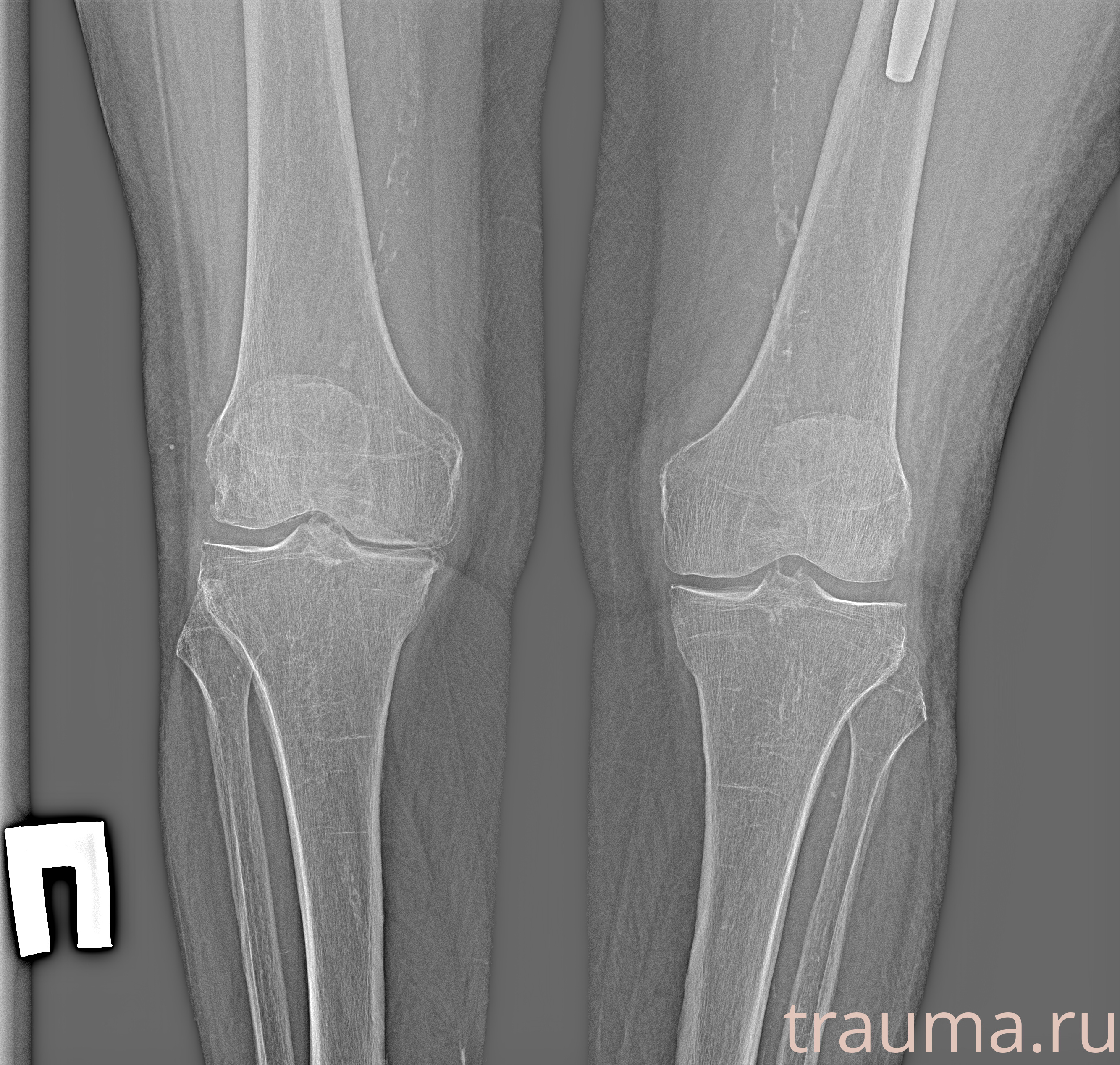 Рентген на дому: по вашему адресу приезжает врач-рентгенолог, травматолог-ортопед с мобильным рентгеновским аппаратом, проводит диагностику травмы или заболевания, делает необходимые рентгенограммы, дает рекомендации по дальнейшему лечению. Получить качественные снимки в домашних условиях возможно благодаря уникальной методике, разработанной МосРентген Центром для института  Склифосовского
