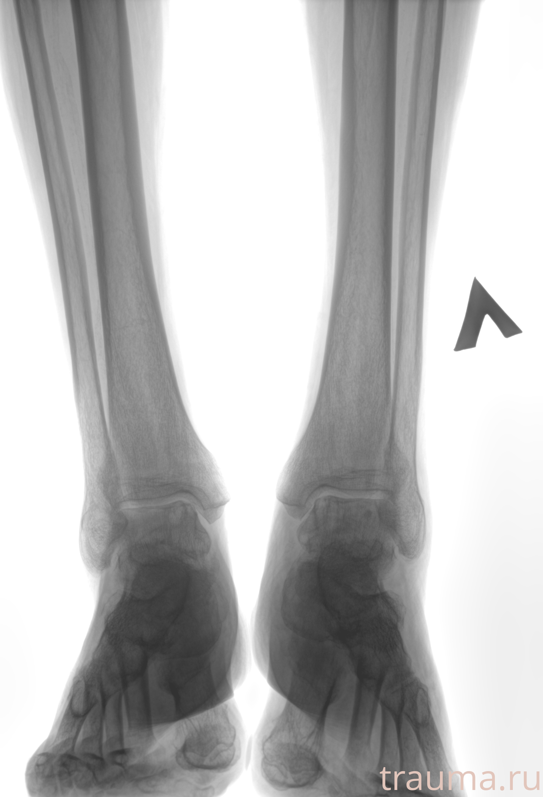 Рентген на дому: по вашему адресу приезжает врач-рентгенолог, травматолог-ортопед с мобильным рентгеновским аппаратом, проводит диагностику травмы или заболевания, делает необходимые рентгенограммы, дает рекомендации по дальнейшему лечению. Получить качественные снимки в домашних условиях возможно благодаря уникальной методике, разработанной МосРентген Центром для института  Склифосовского