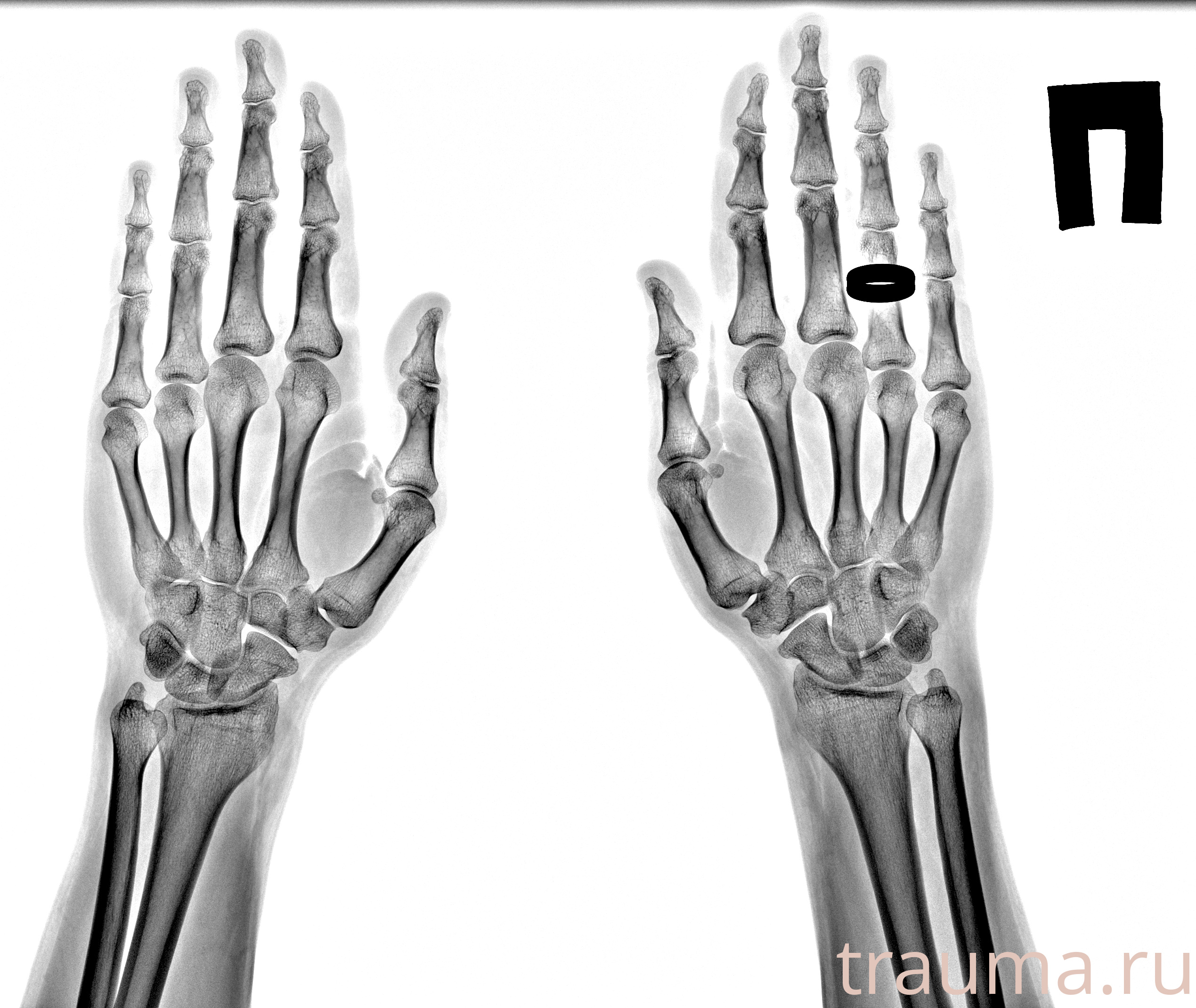 Рентген на дому: по вашему адресу приезжает врач-рентгенолог, травматолог-ортопед с мобильным рентгеновским аппаратом, проводит диагностику травмы или заболевания, делает необходимые рентгенограммы, дает рекомендации по дальнейшему лечению. Получить качественные снимки в домашних условиях возможно благодаря уникальной методике, разработанной МосРентген Центром для института  Склифосовского