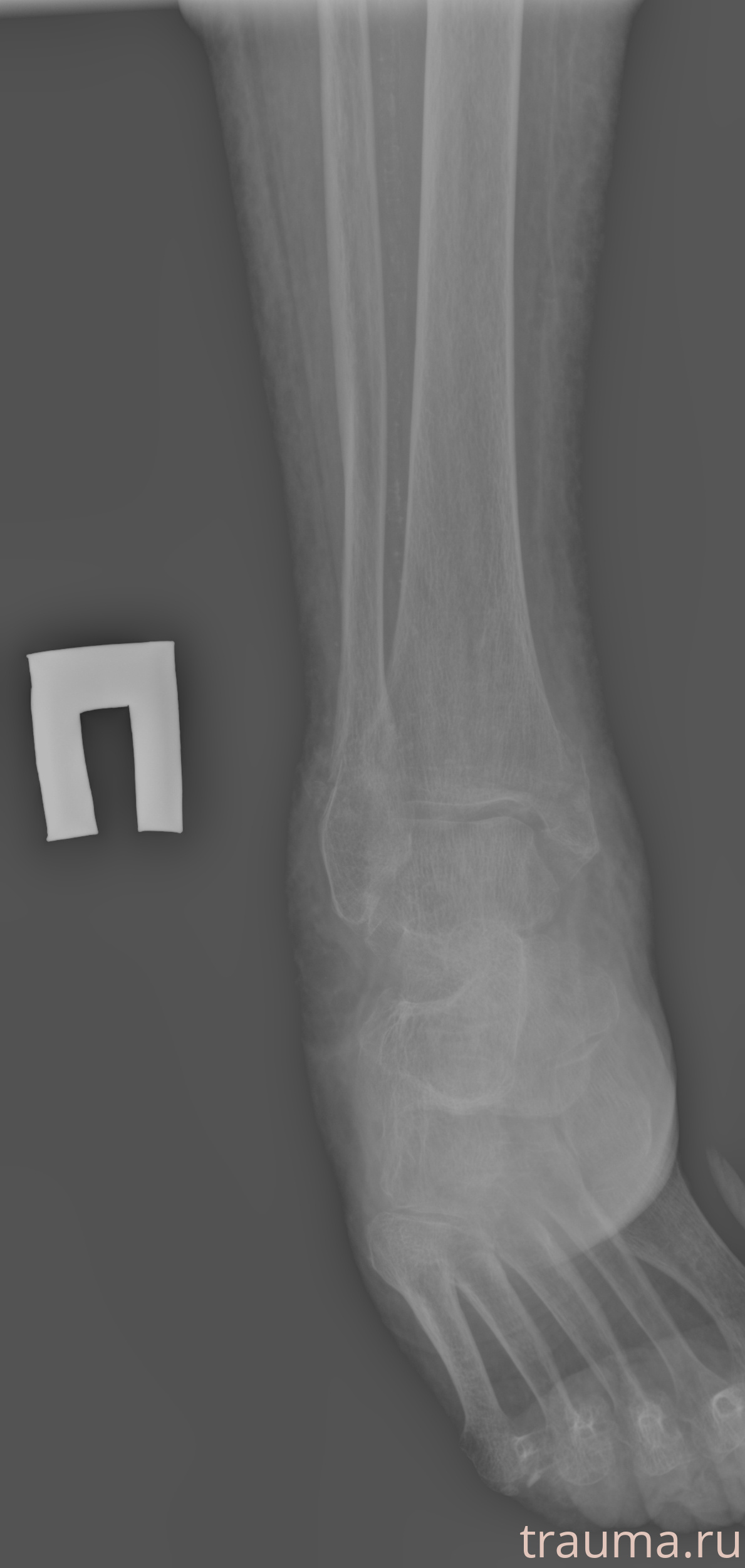 Рентген на дому: по вашему адресу приезжает врач-рентгенолог, травматолог-ортопед с мобильным рентгеновским аппаратом, проводит диагностику травмы или заболевания, делает необходимые рентгенограммы, дает рекомендации по дальнейшему лечению. Получить качественные снимки в домашних условиях возможно благодаря уникальной методике, разработанной МосРентген Центром для института  Склифосовского